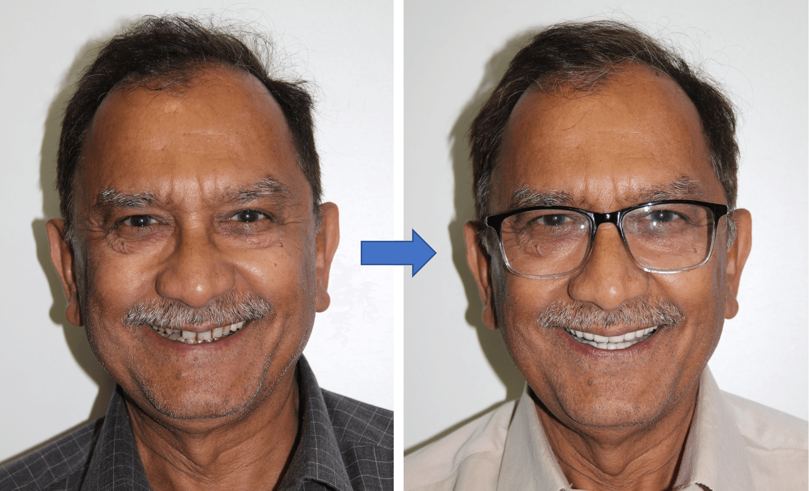 Full Mouth Rehabilitation result 1