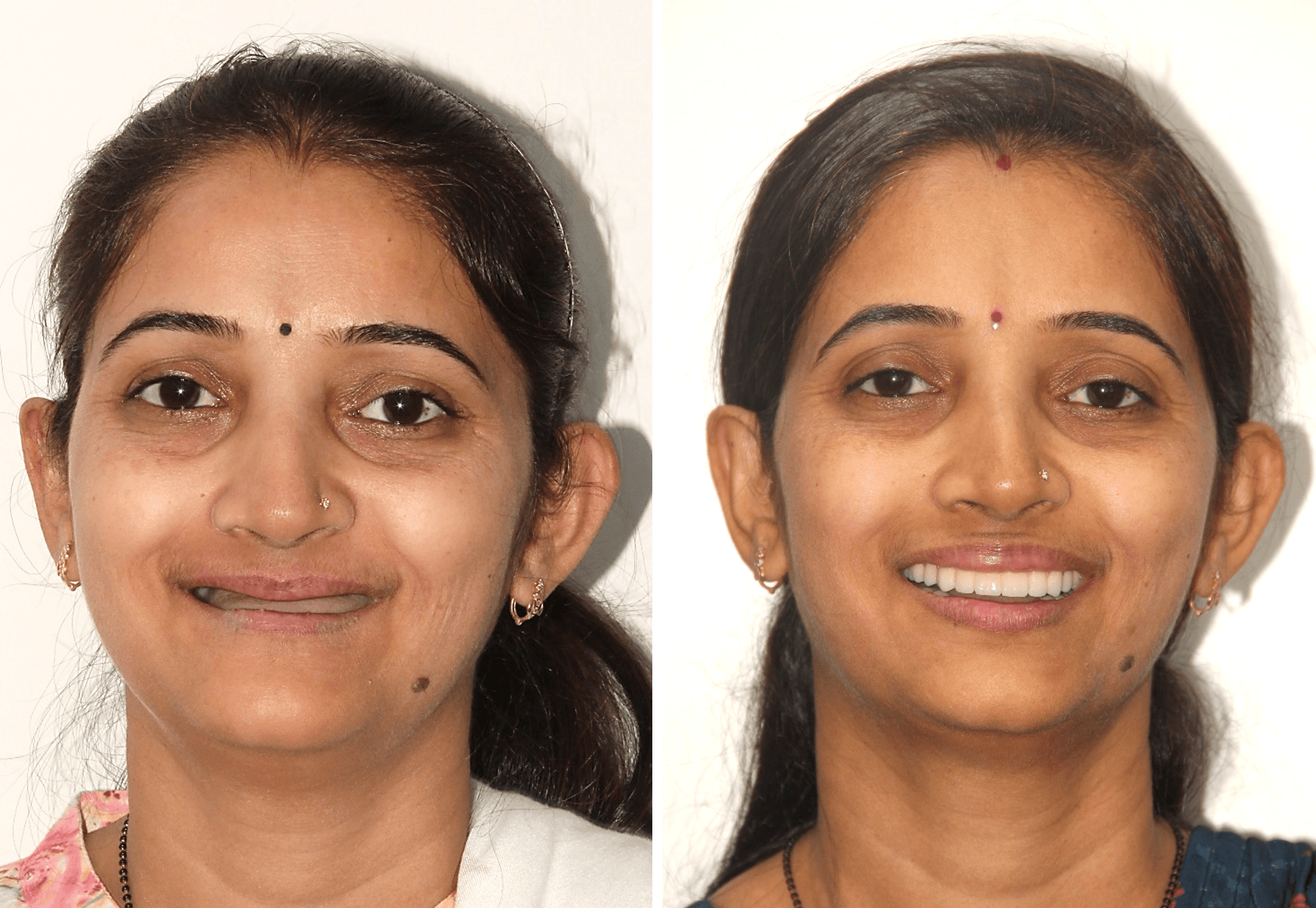 Dental Implant result 1