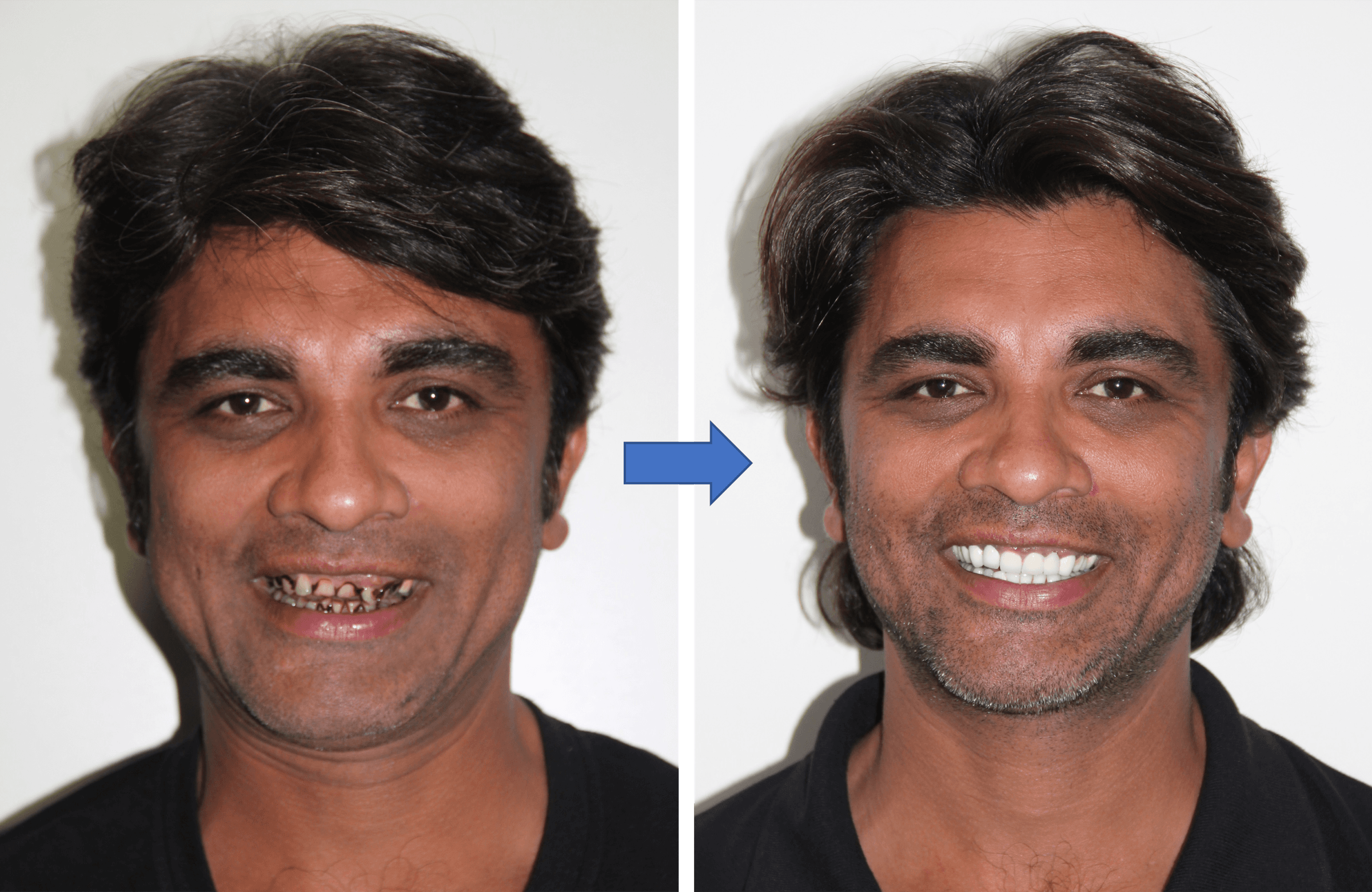 Full Mouth Rehabilitation case result 2 – Lifedent Dental Hospital, Rajkot