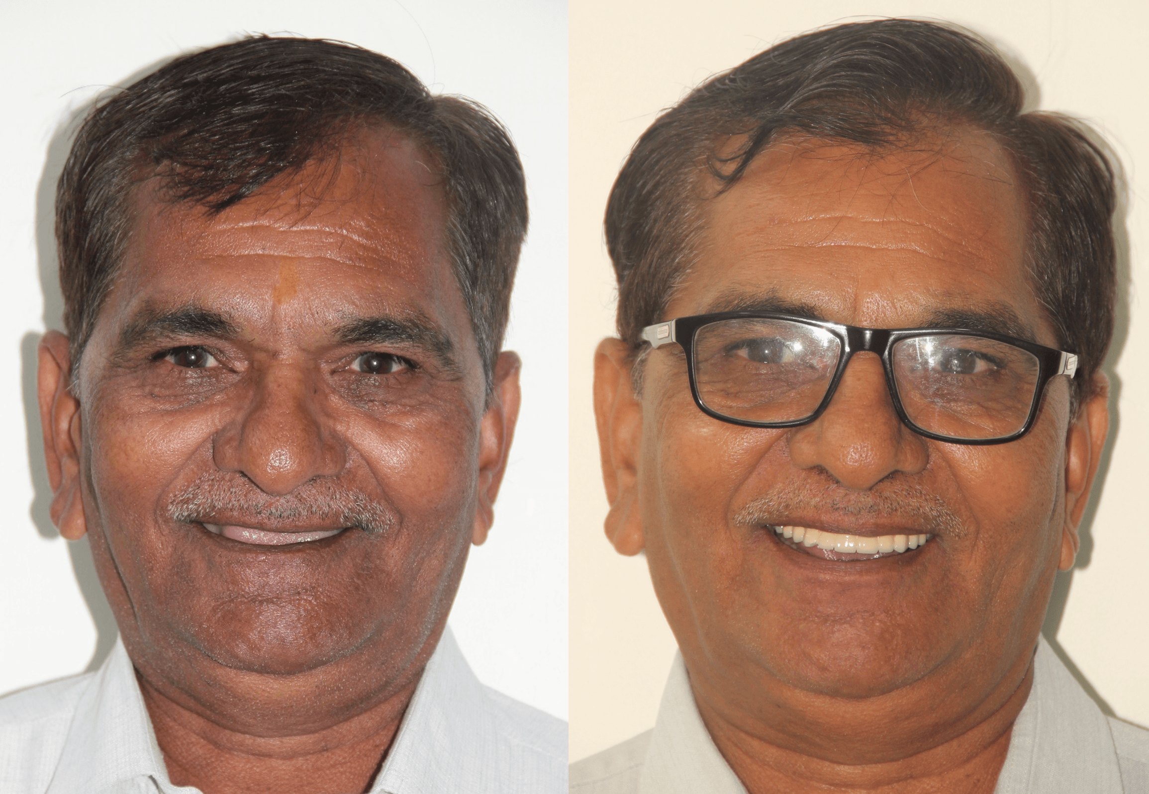 Dental Implant result 2