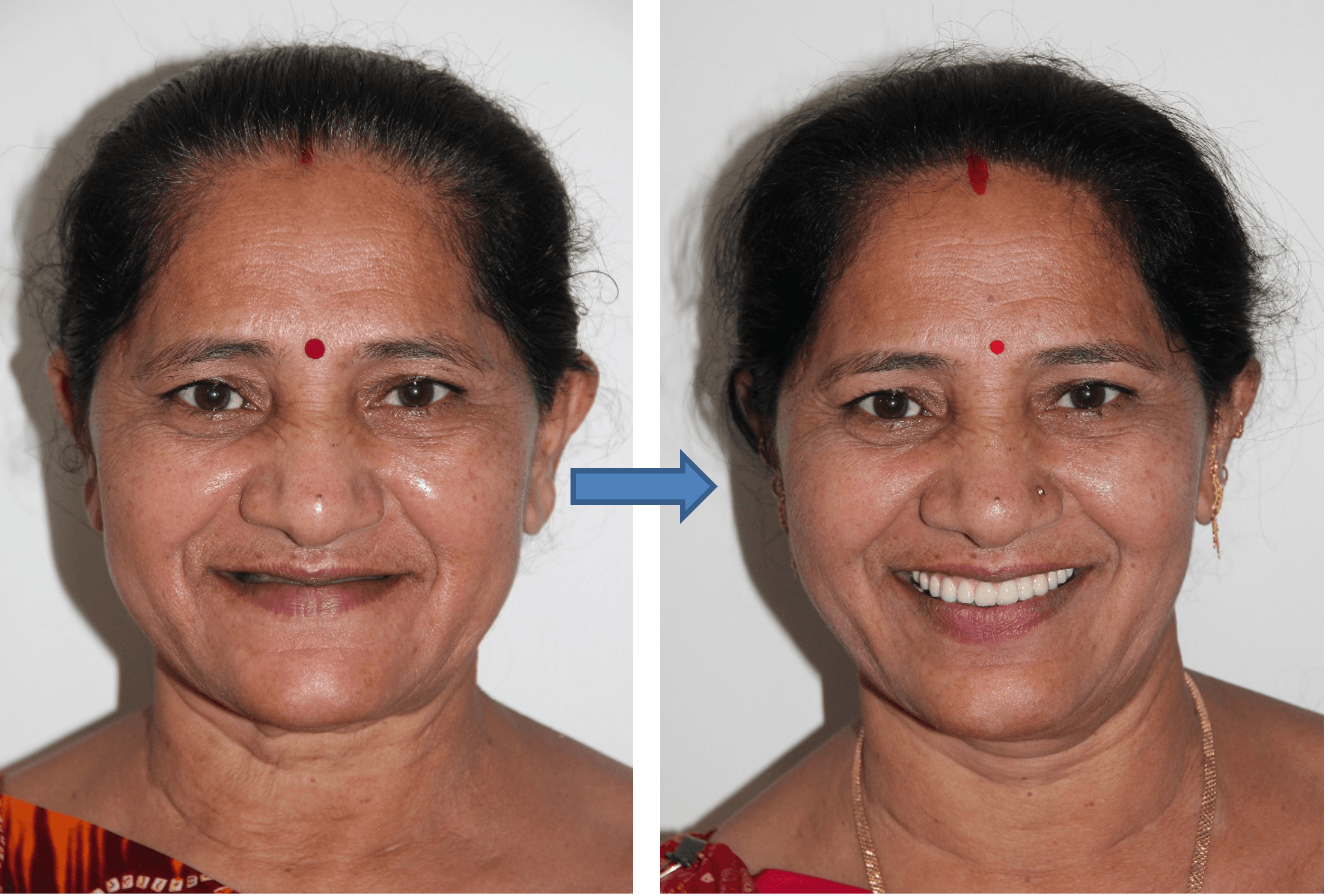 Dental Implant result 3