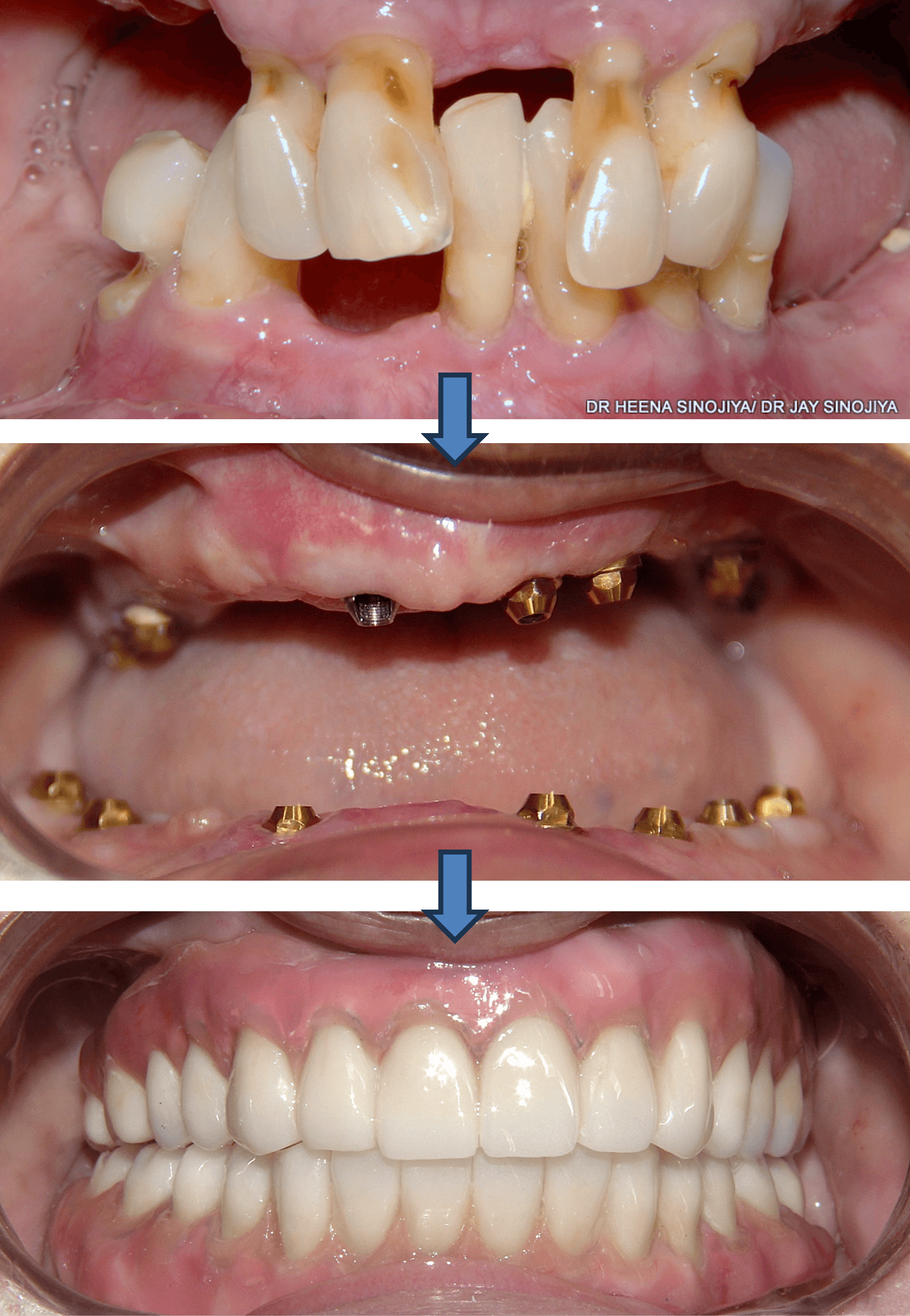 Dental Implant result 4