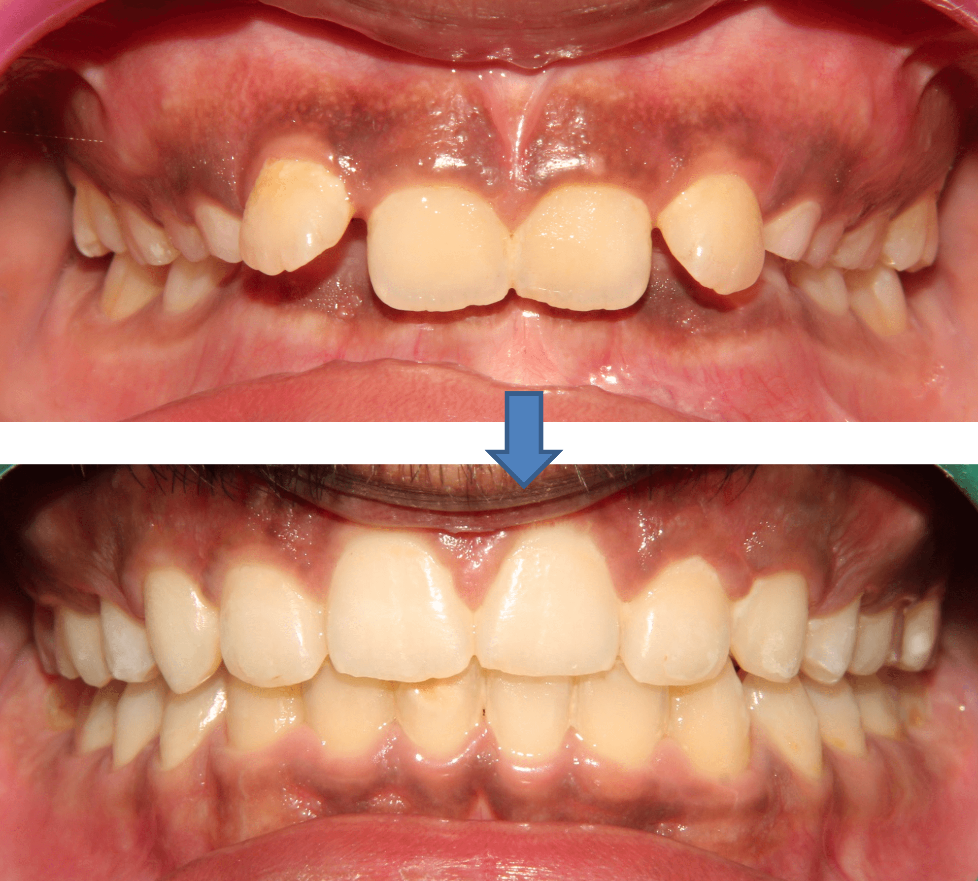 Invisible Aligners result 4