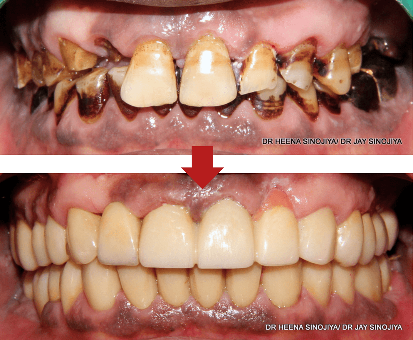 Full Mouth Rehabilitation result 5