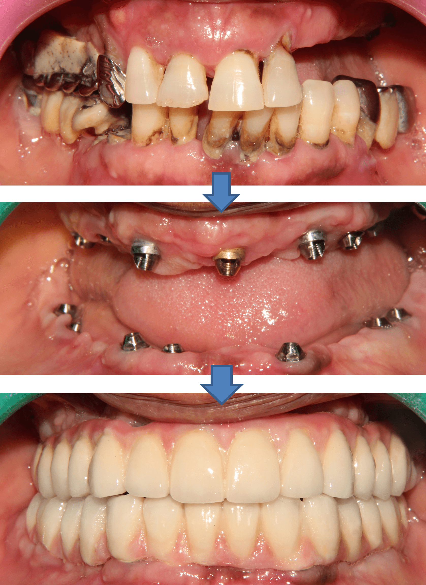 Dental Implant result 5