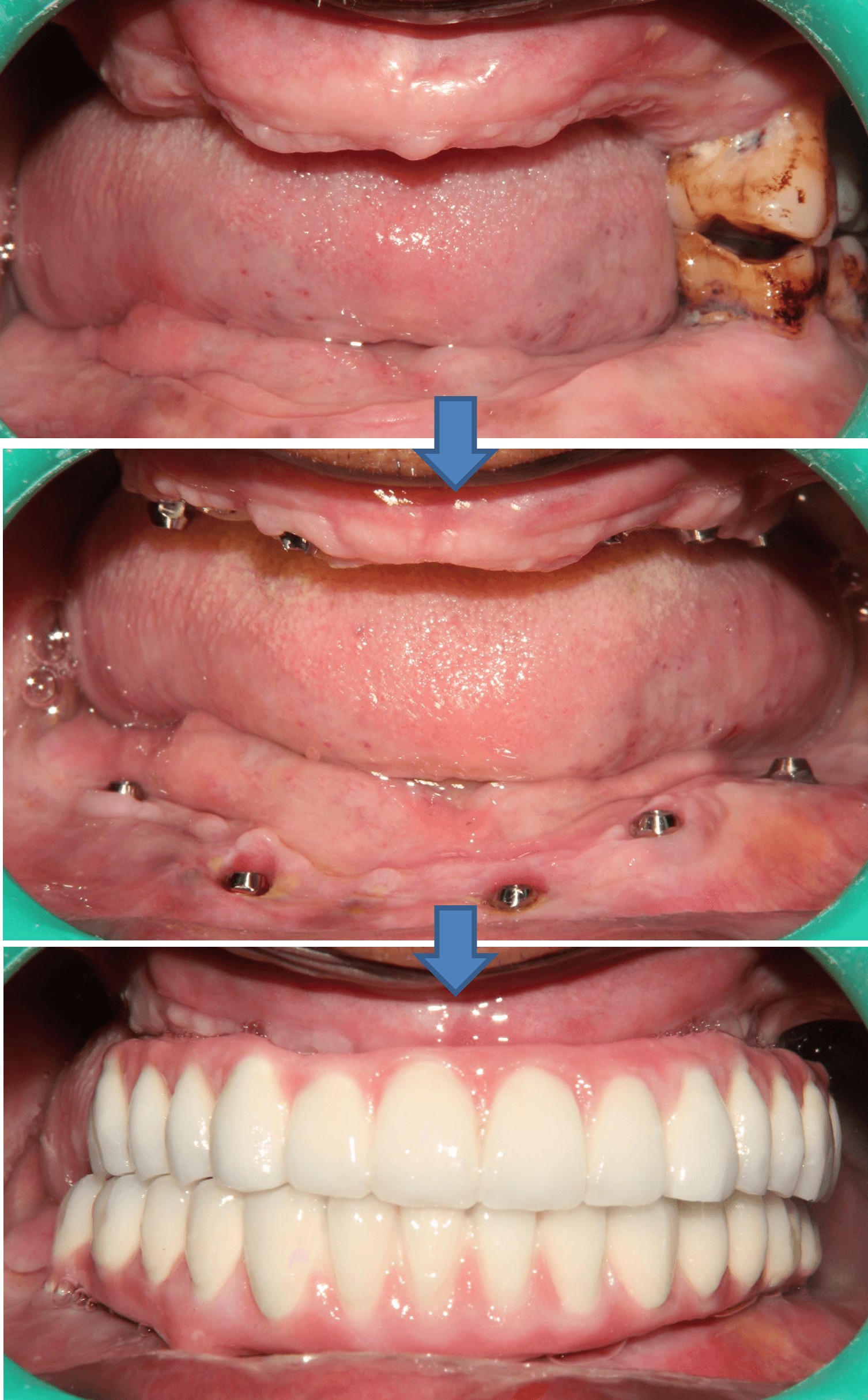 Dental Implant result 6