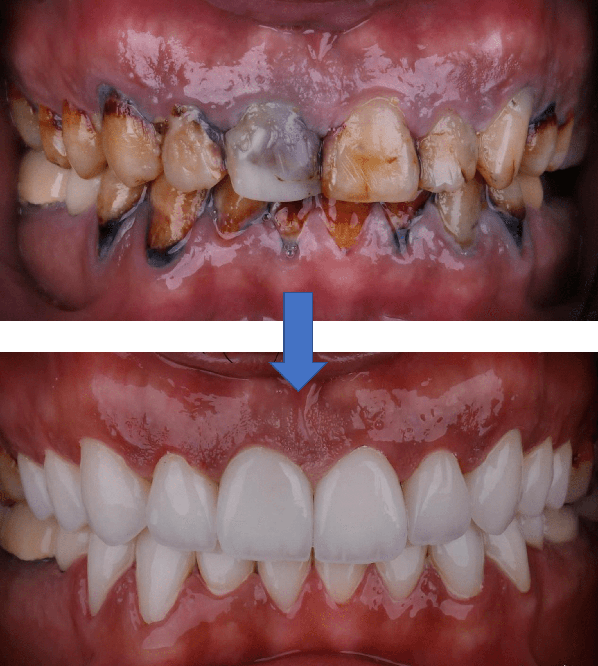Full Mouth Rehabilitation result 6