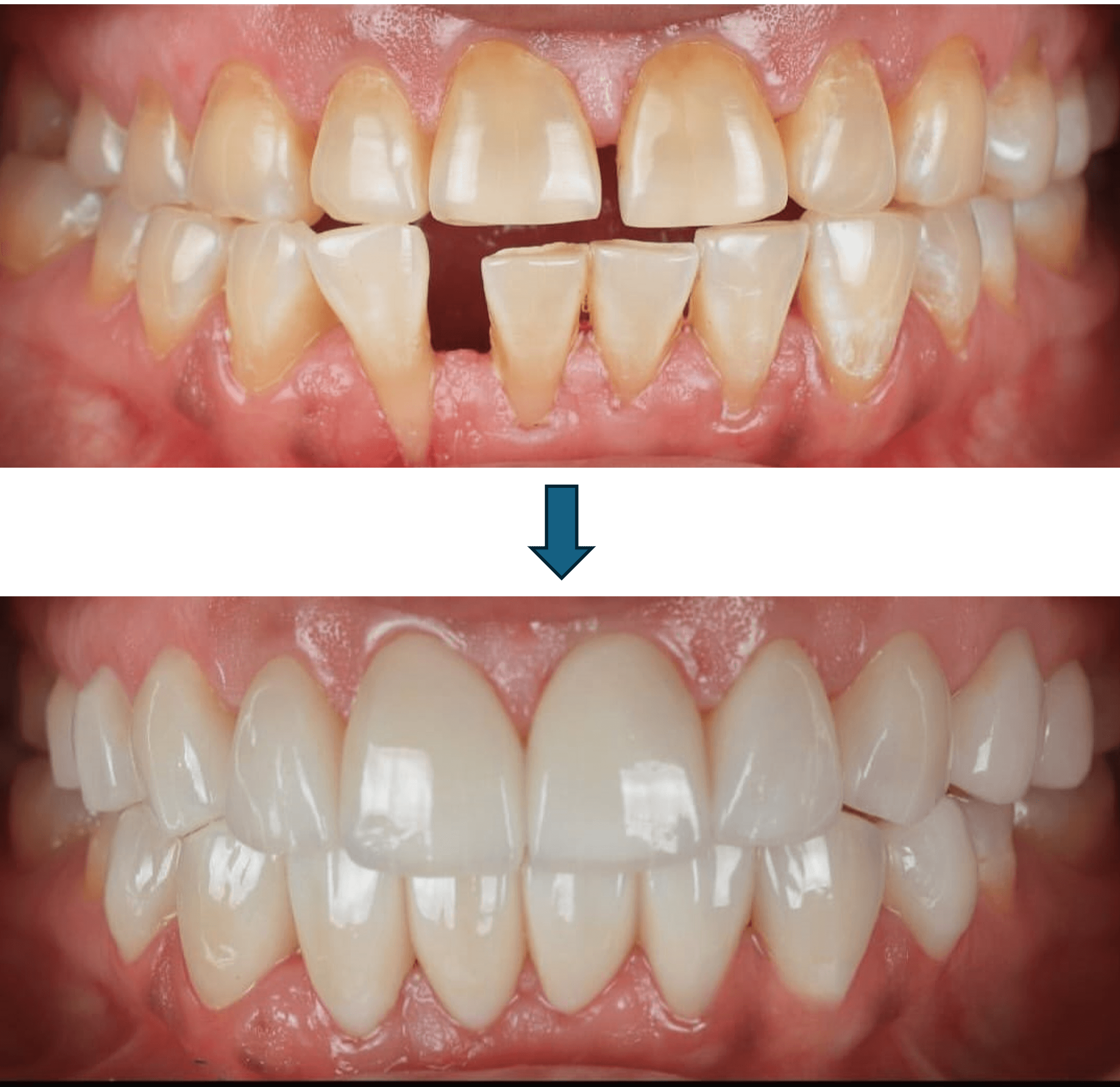 Smile Makeover result 6