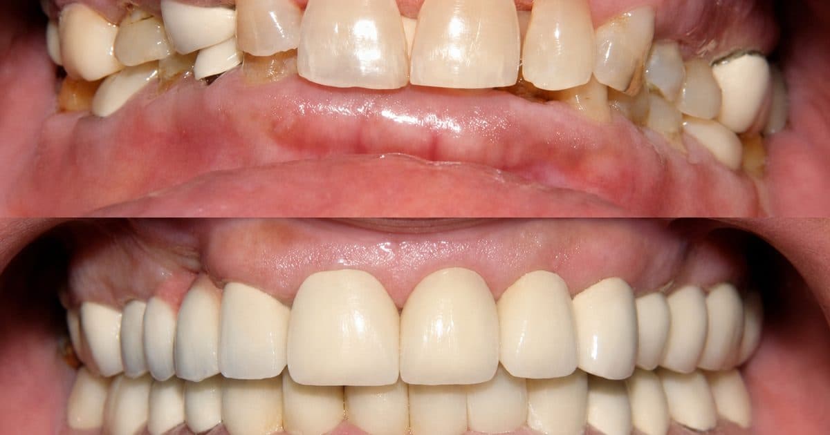 Implant-Supported Dentures vs Regular Dentures