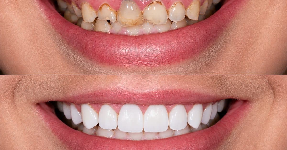 Smile Makeover Before a Wedding: How Much Time to Allow
