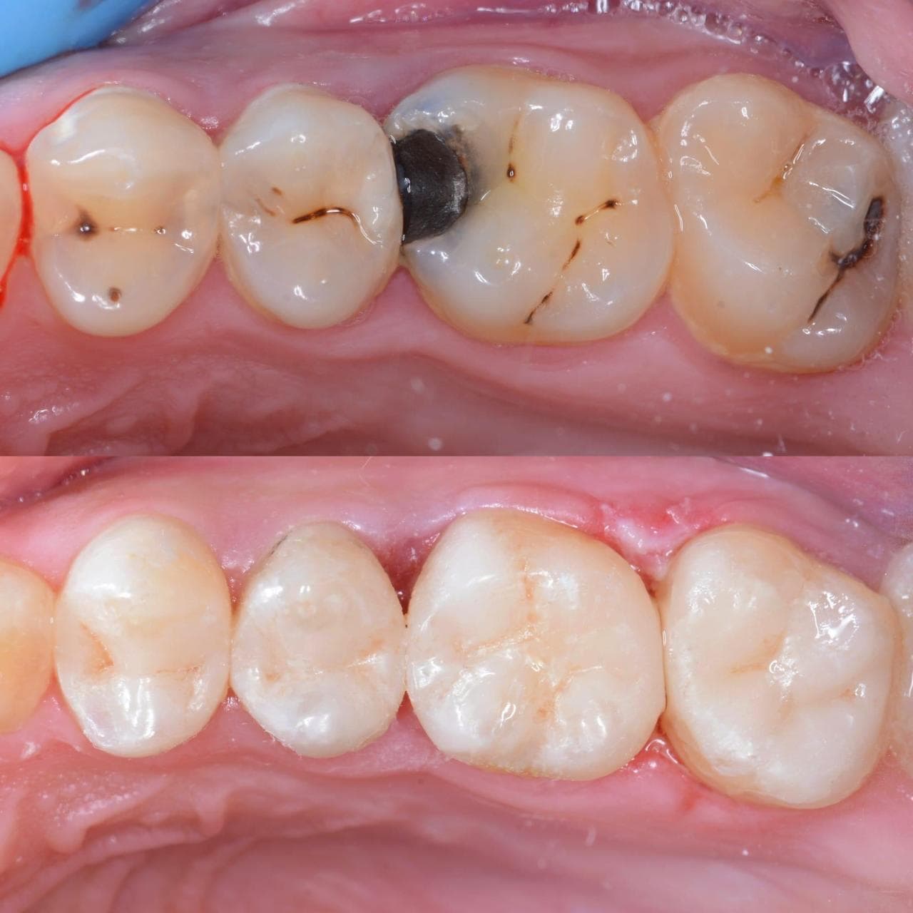 Tooth-Colored Filling result 1