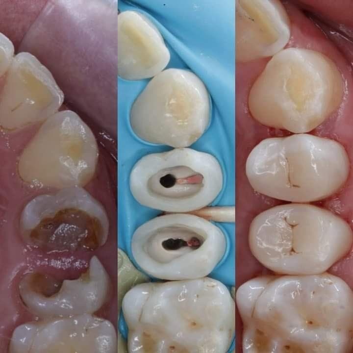 Root Canal Treatment result 1