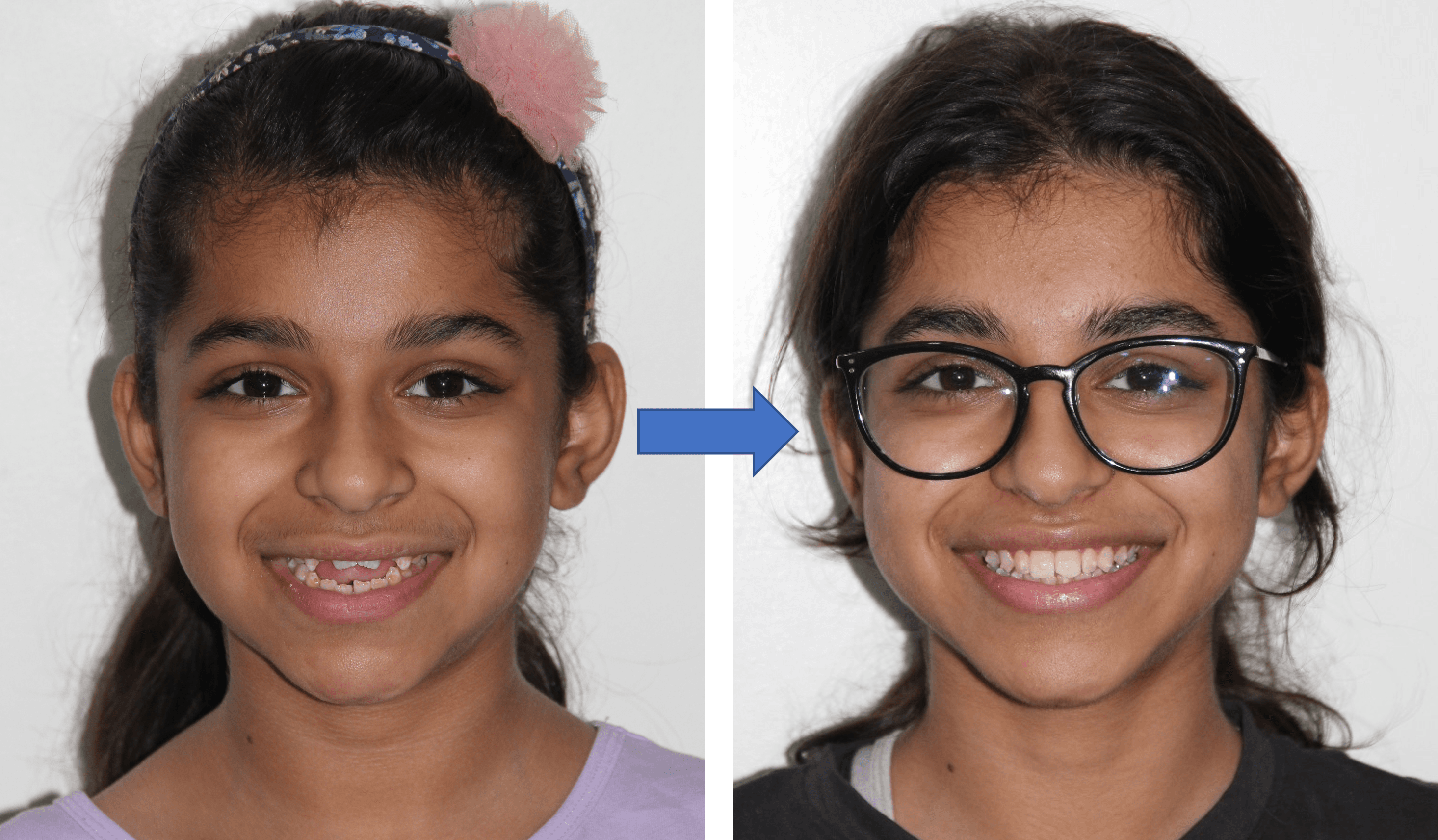 Invisible Aligners result 1