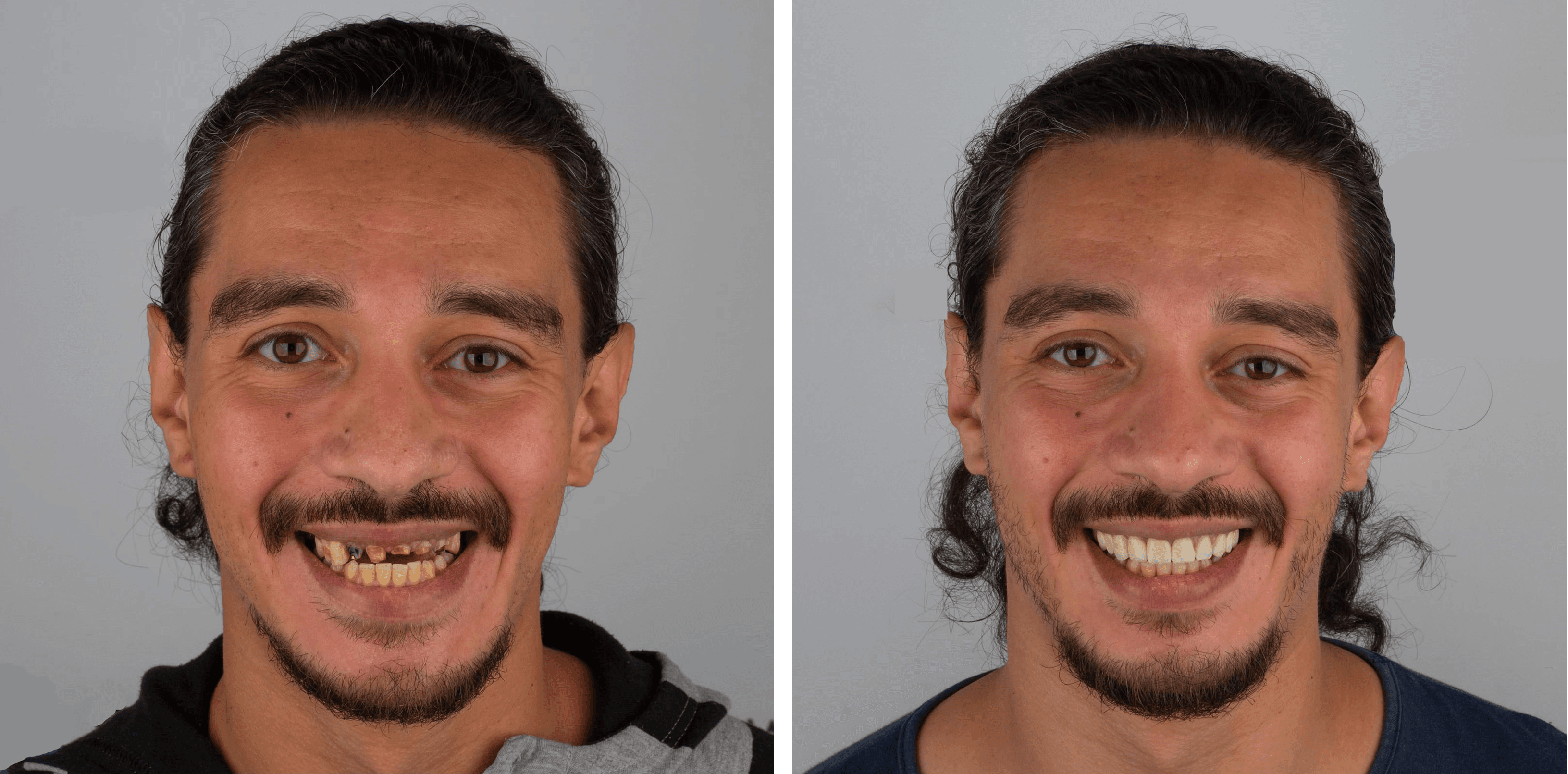 Smile Makeover result 1