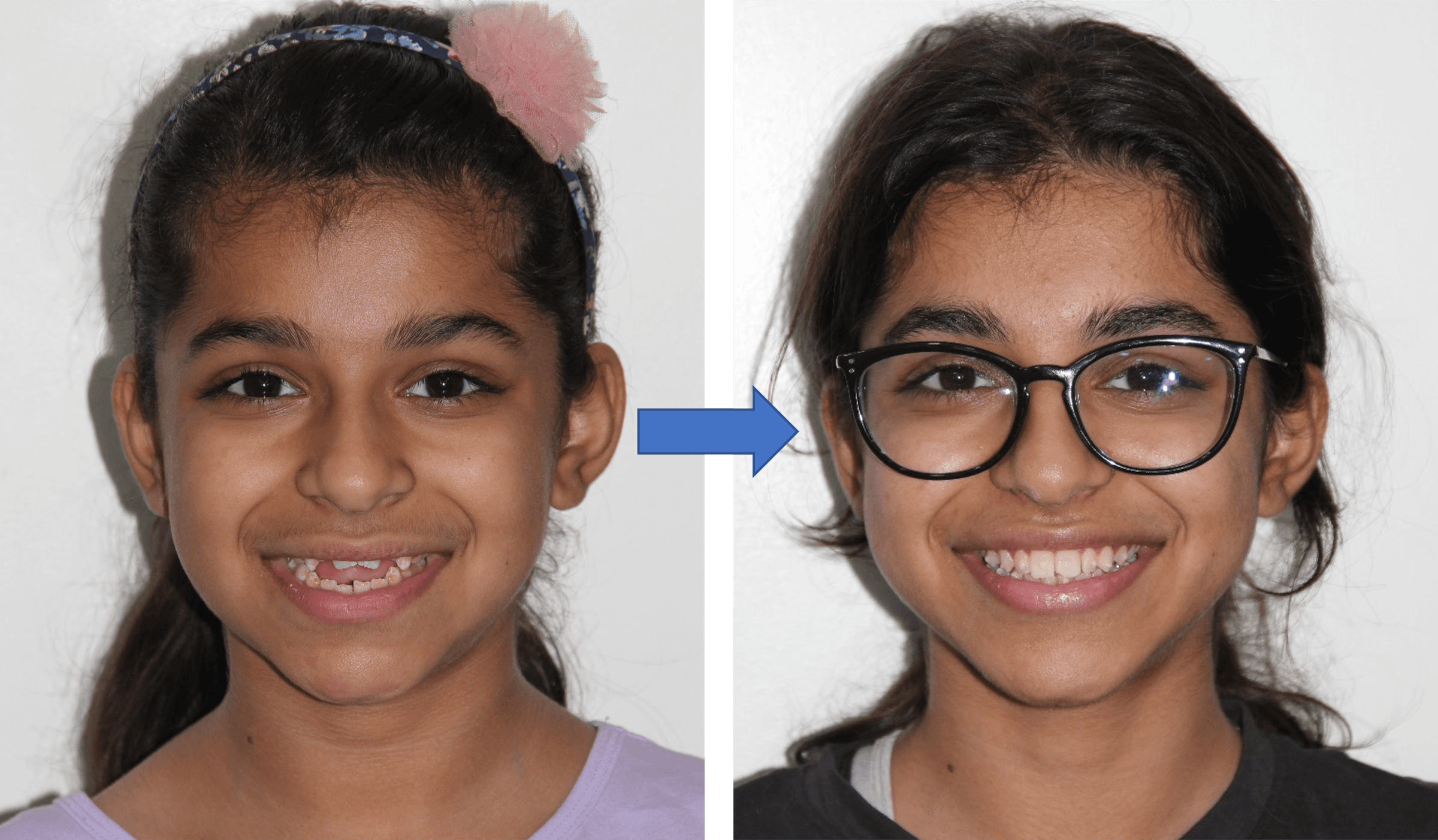 Invisible Aligners case result 1 – Lifedent Dental Hospital, Rajkot
