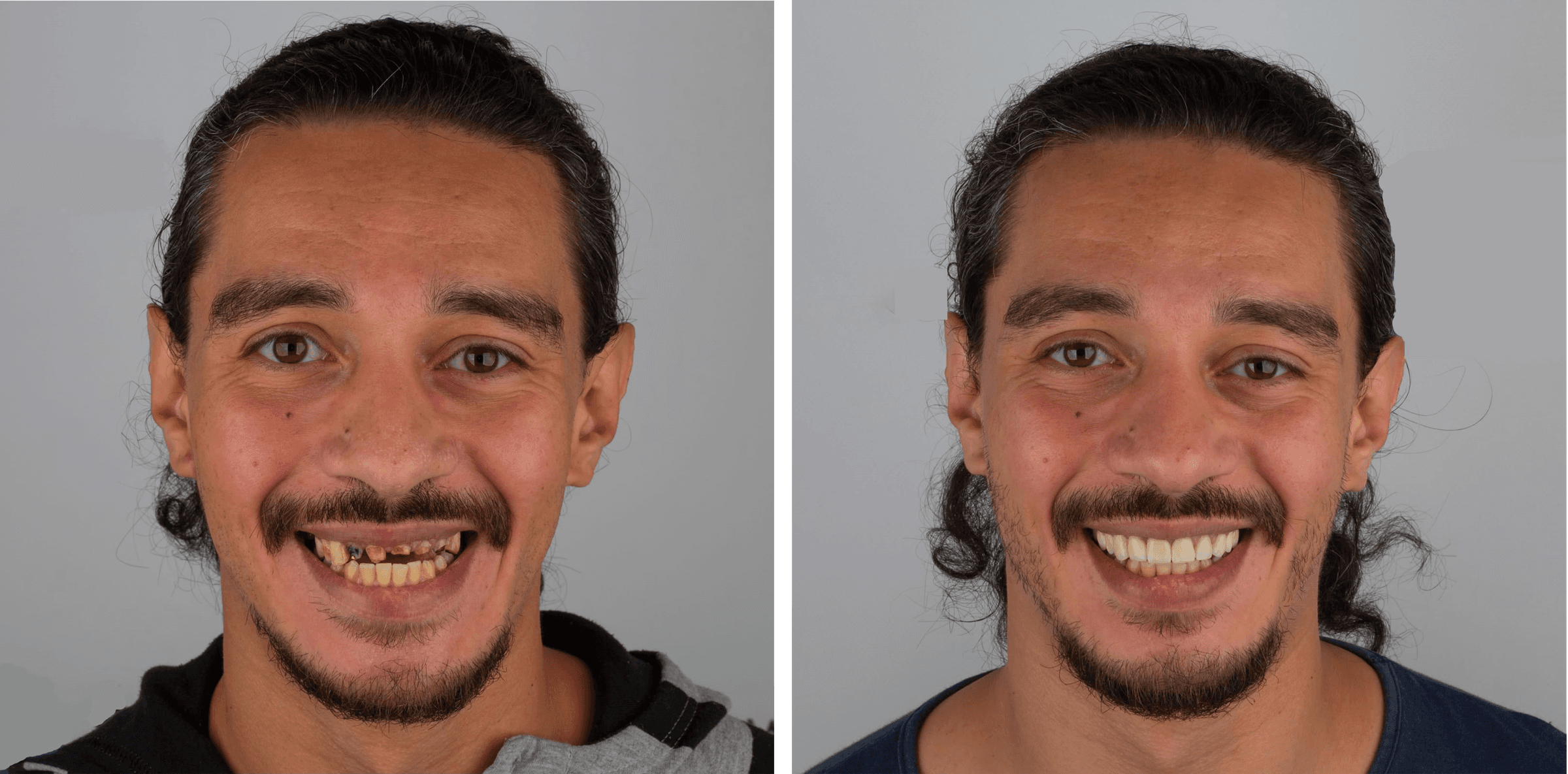 Smile Designing case result 1 – Lifedent Dental Hospital, Rajkot