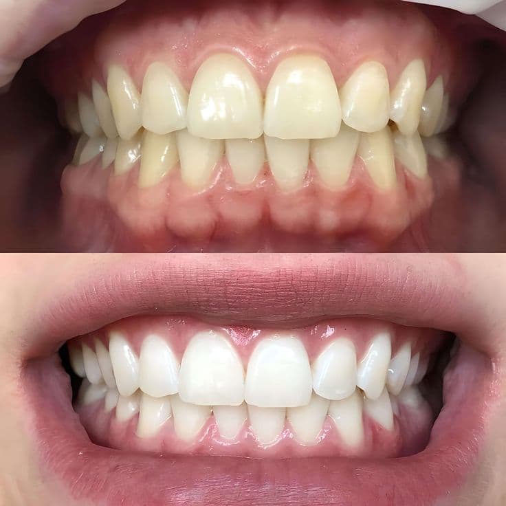 Teeth Whitening result 1