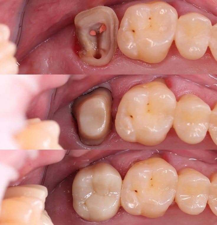 Root Canal Treatment result 2