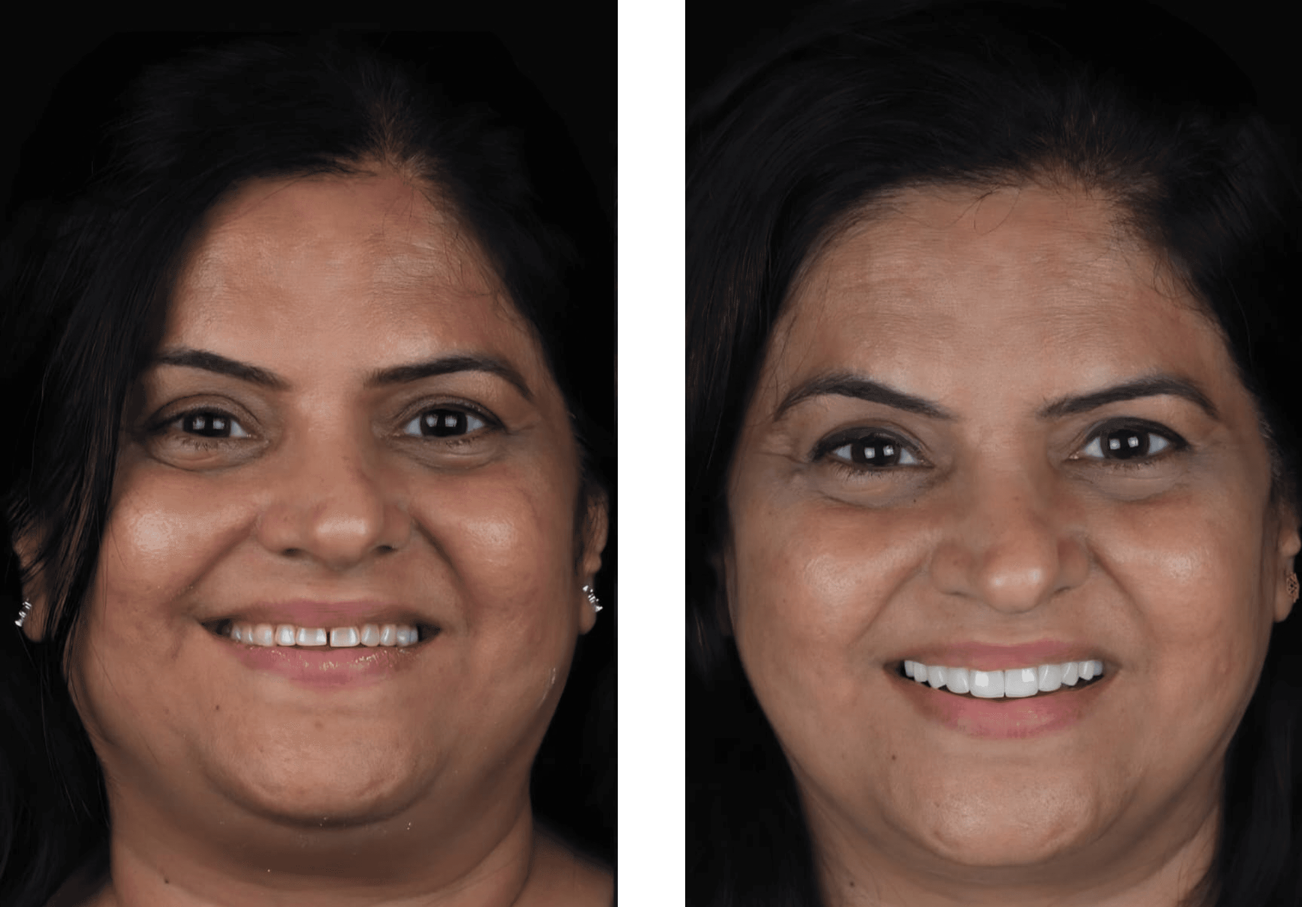 Smile Makeover result 2