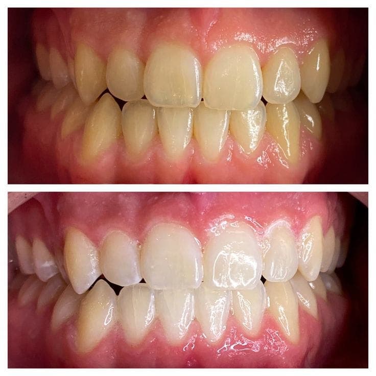 Teeth Whitening result 2