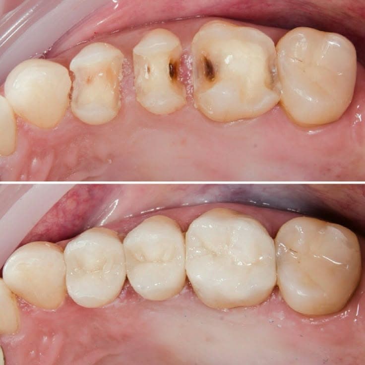Tooth-Colored Filling result 2