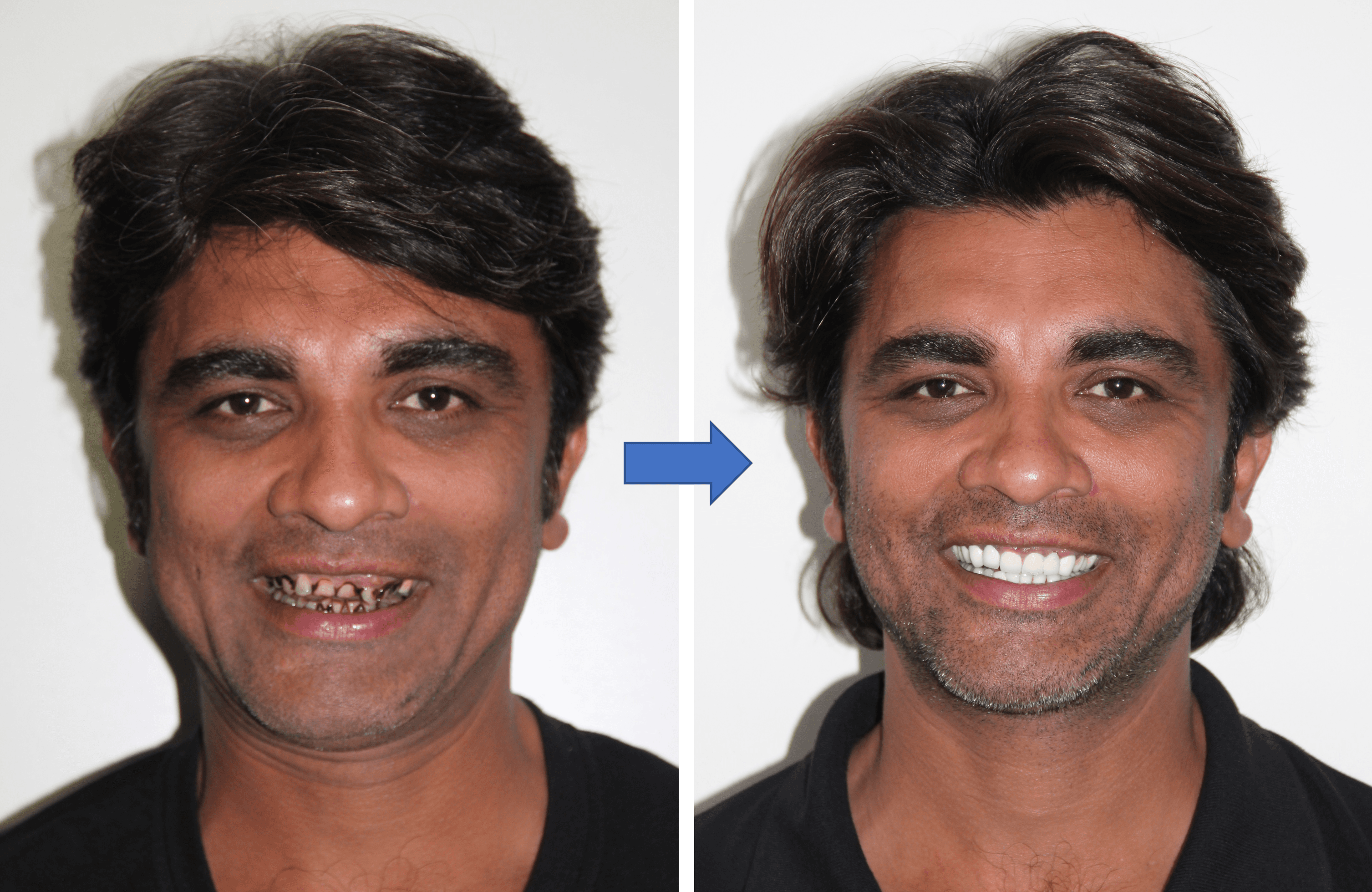 Full Mouth Rehabilitation result 2