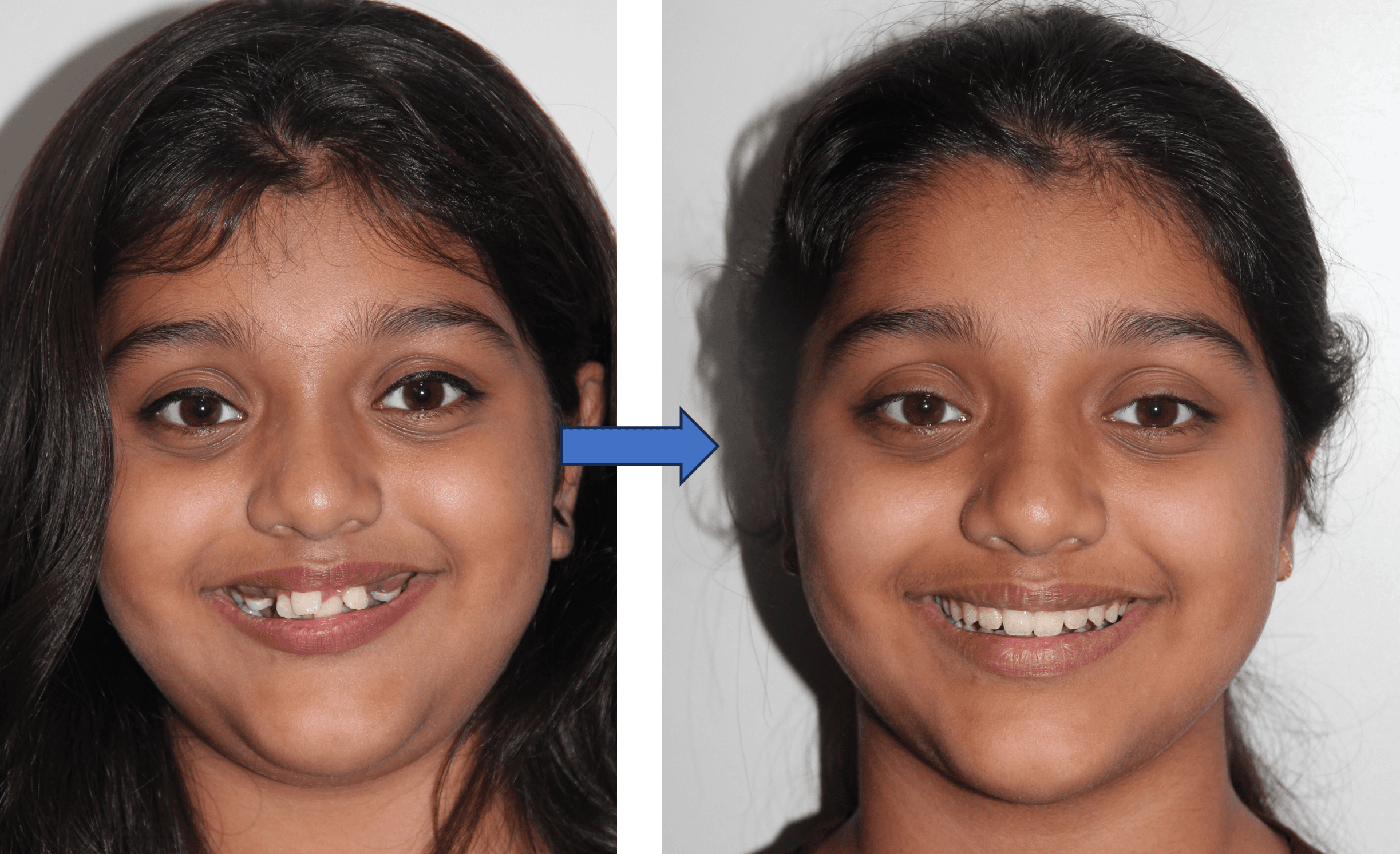 Invisible Aligners result 2