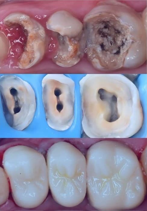 Root Canal Treatment result 3