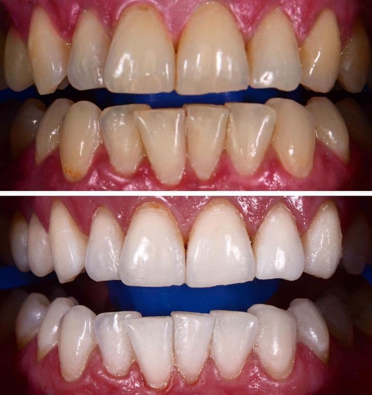 Teeth Whitening result 3