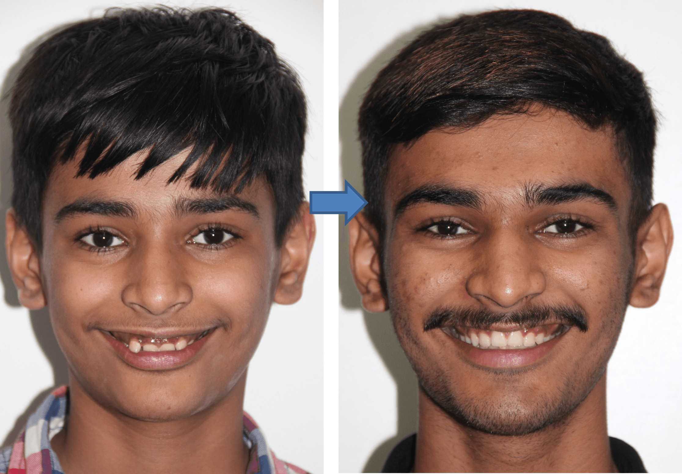 Invisible Aligners result 3