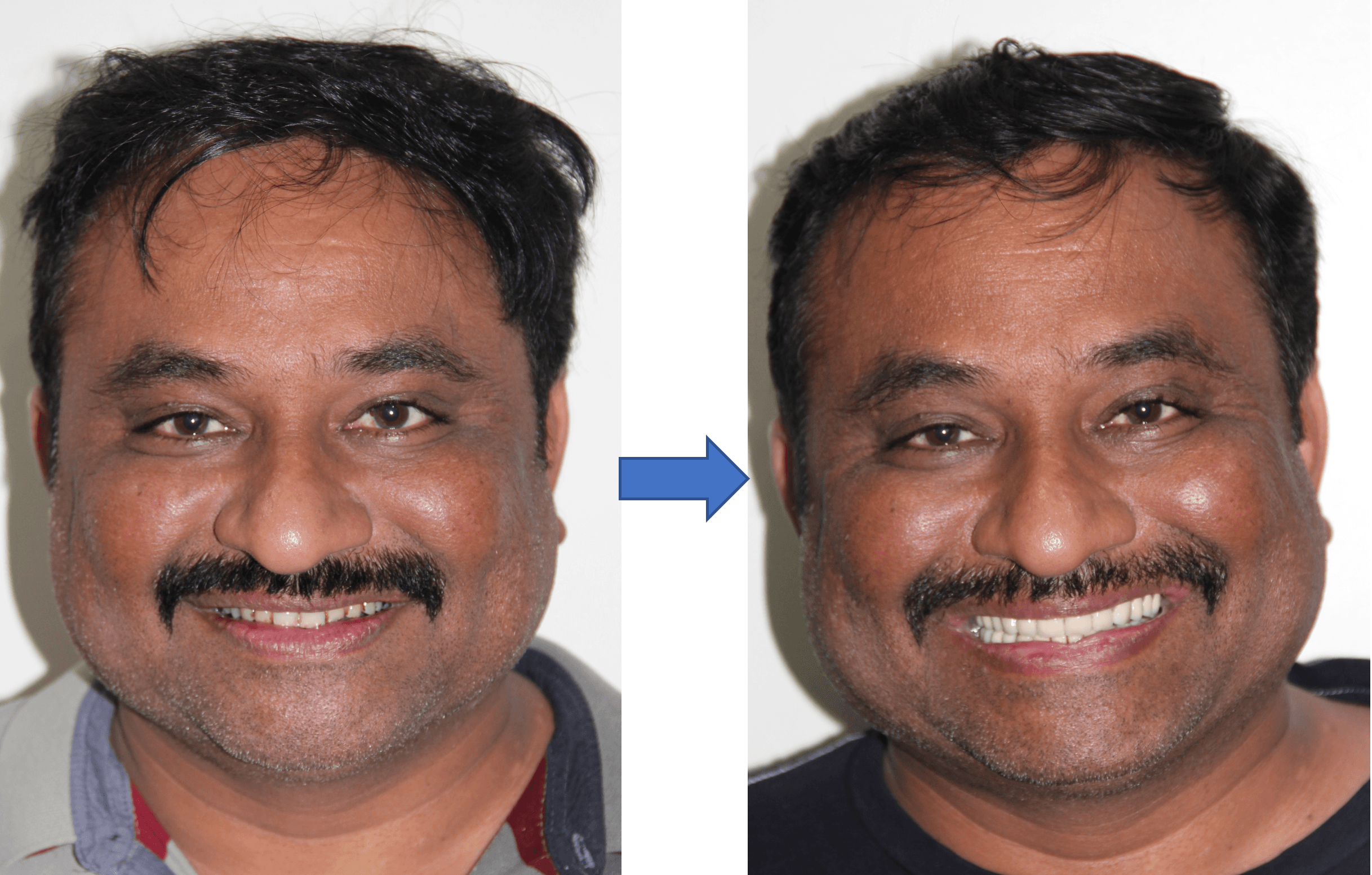 Full Mouth Rehabilitation result 3