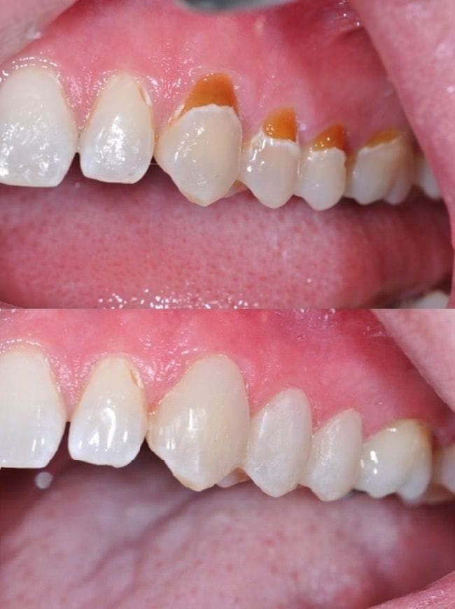 Tooth-Colored Filling result 3
