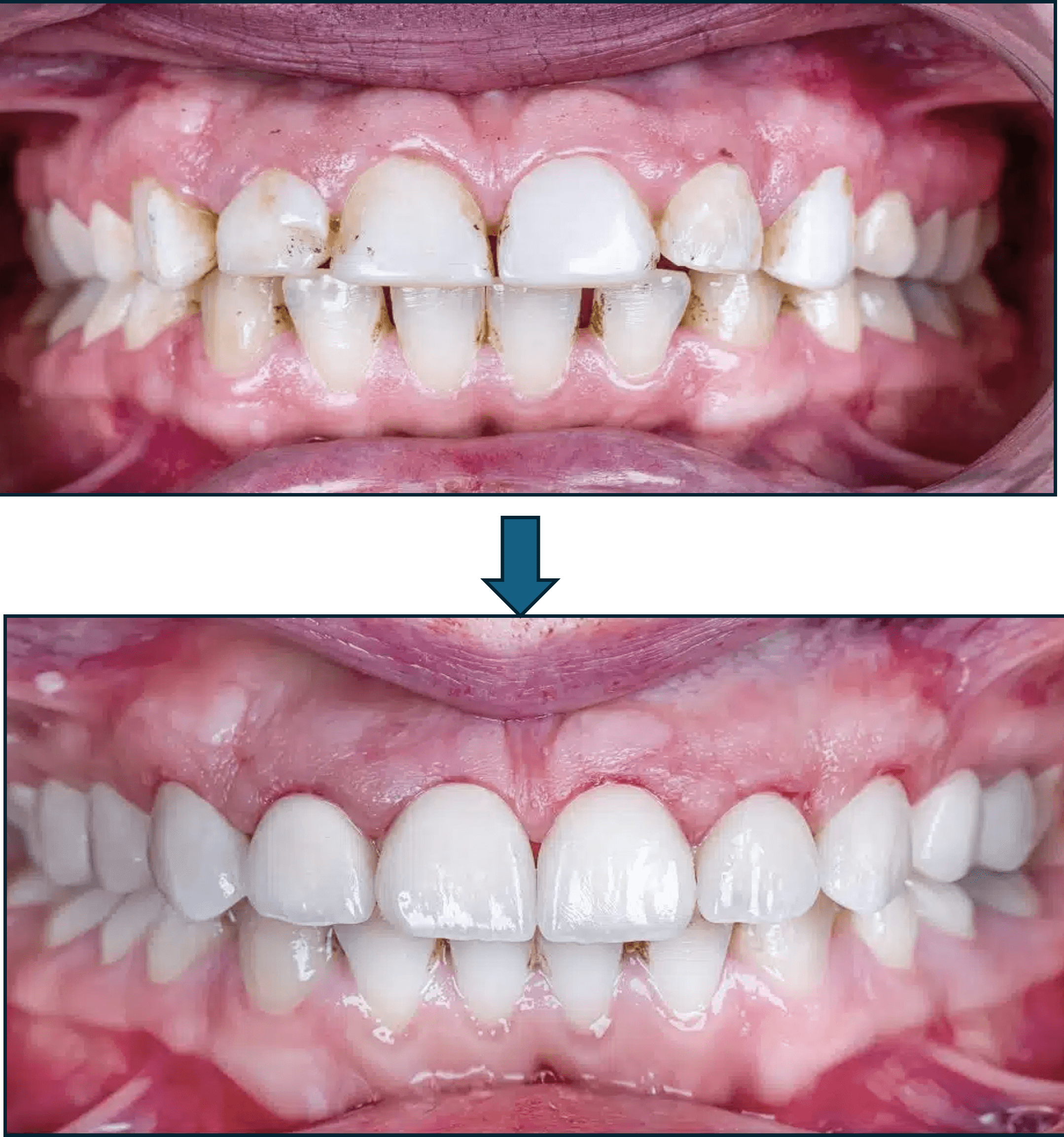Smile Makeover result 4