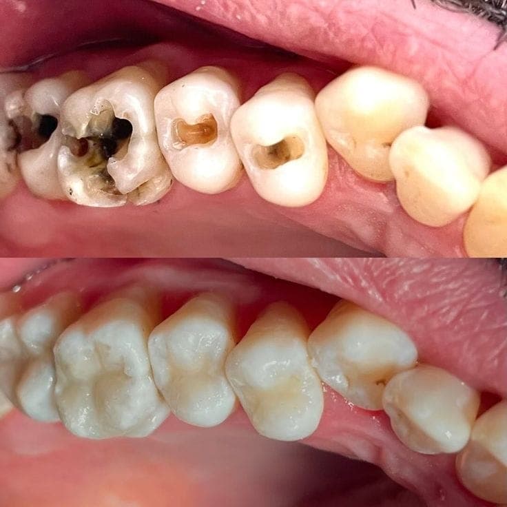 Tooth-Colored Filling result 4