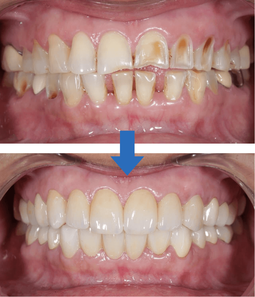Full Mouth Rehabilitation result 4