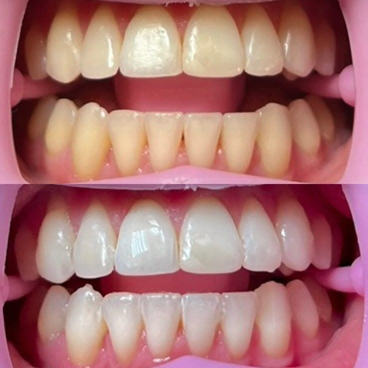 Teeth Whitening result 4