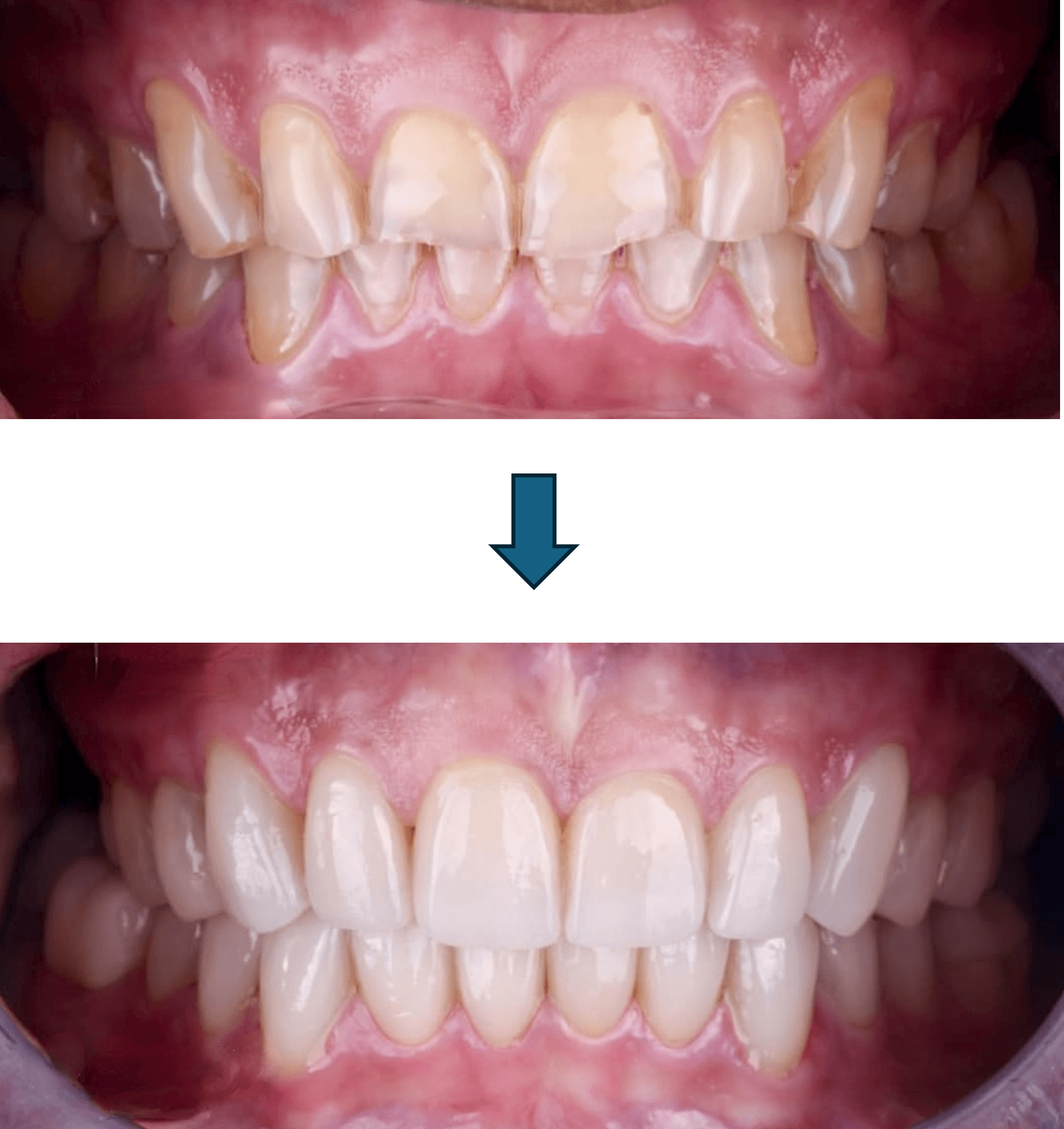 Smile Makeover result 5