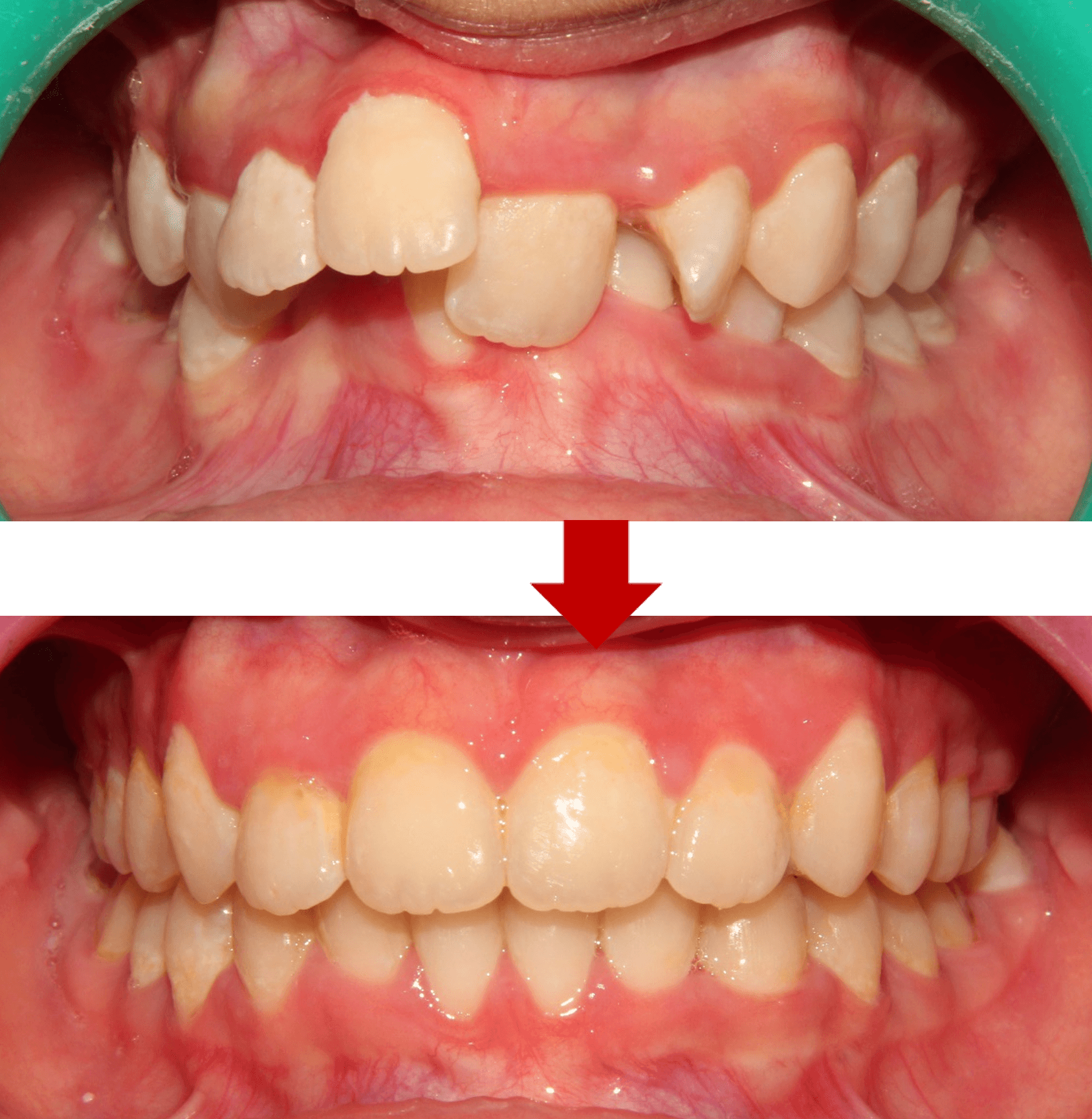 Invisible Aligners result 5