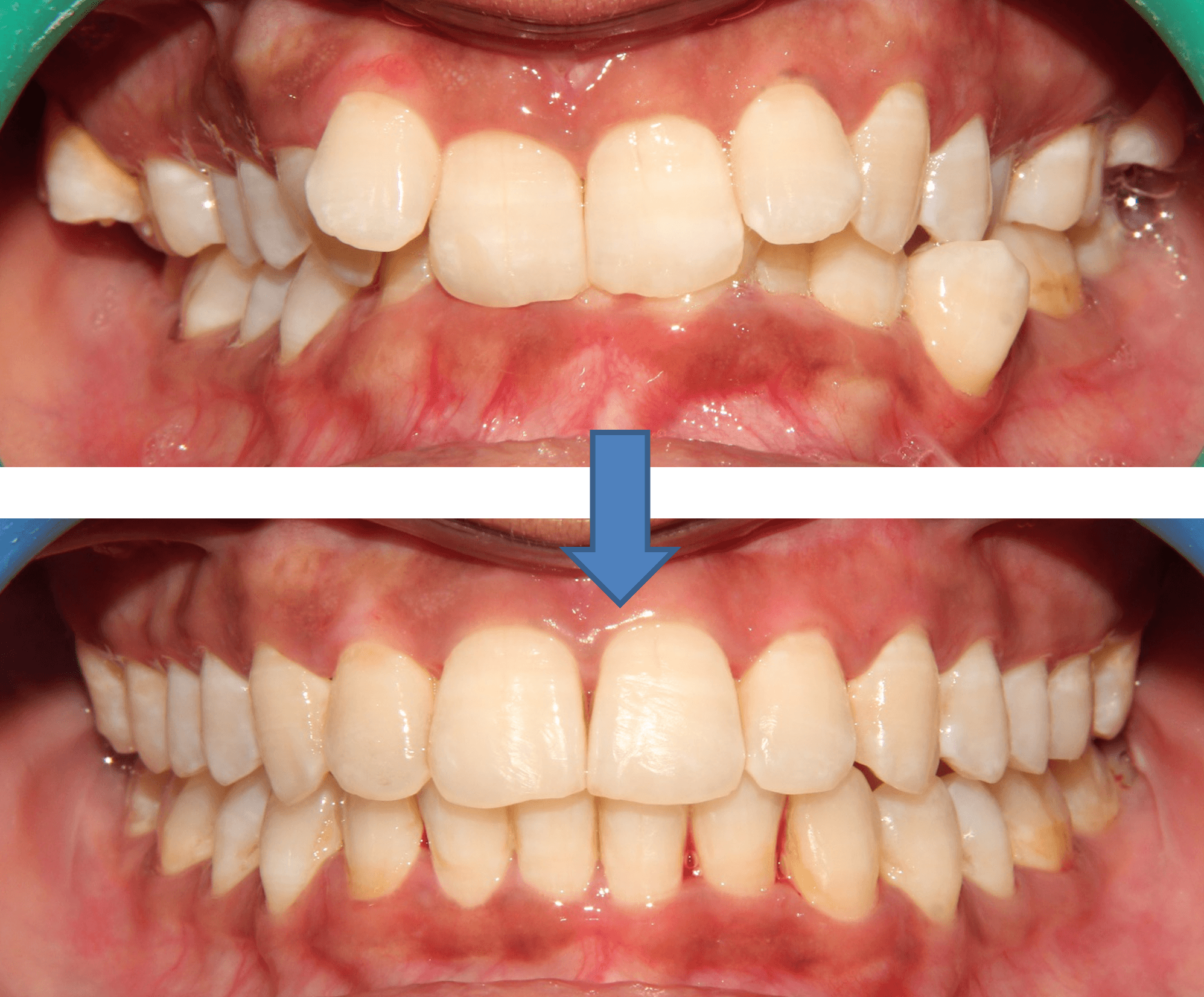 Invisible Aligners result 6