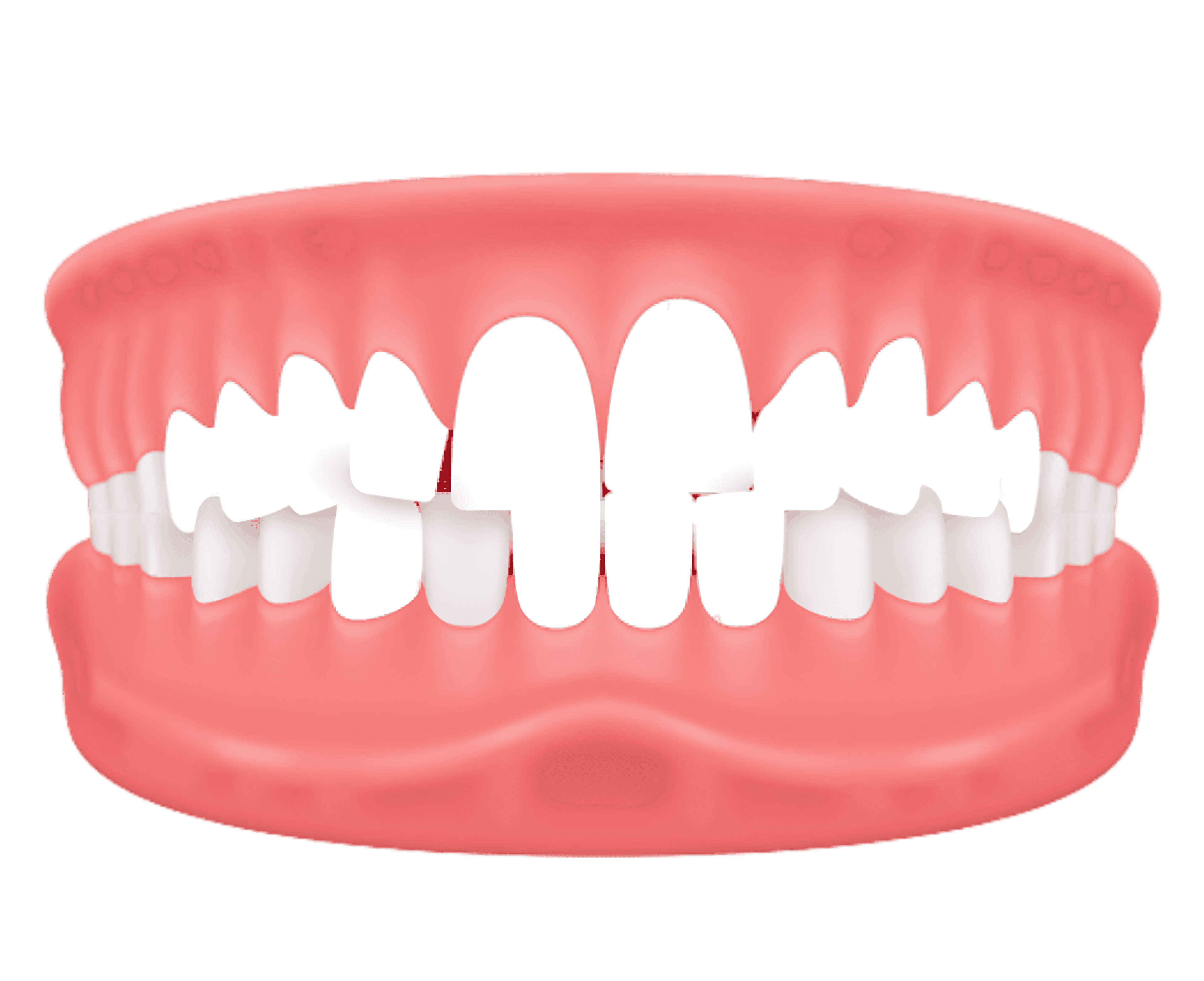 Crowding – overlapping or cramped teeth