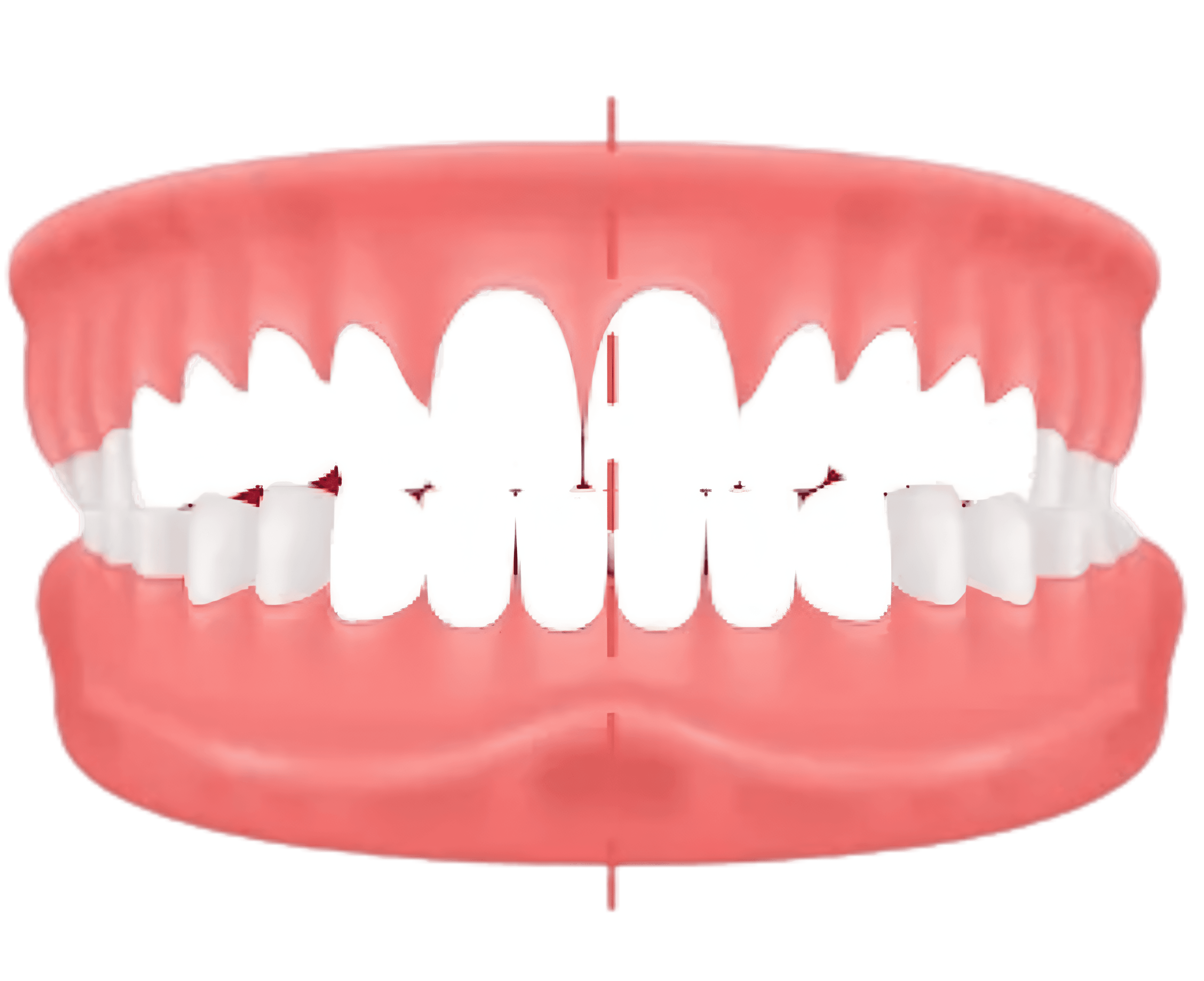 Crossbite – upper teeth sit inside lower teeth