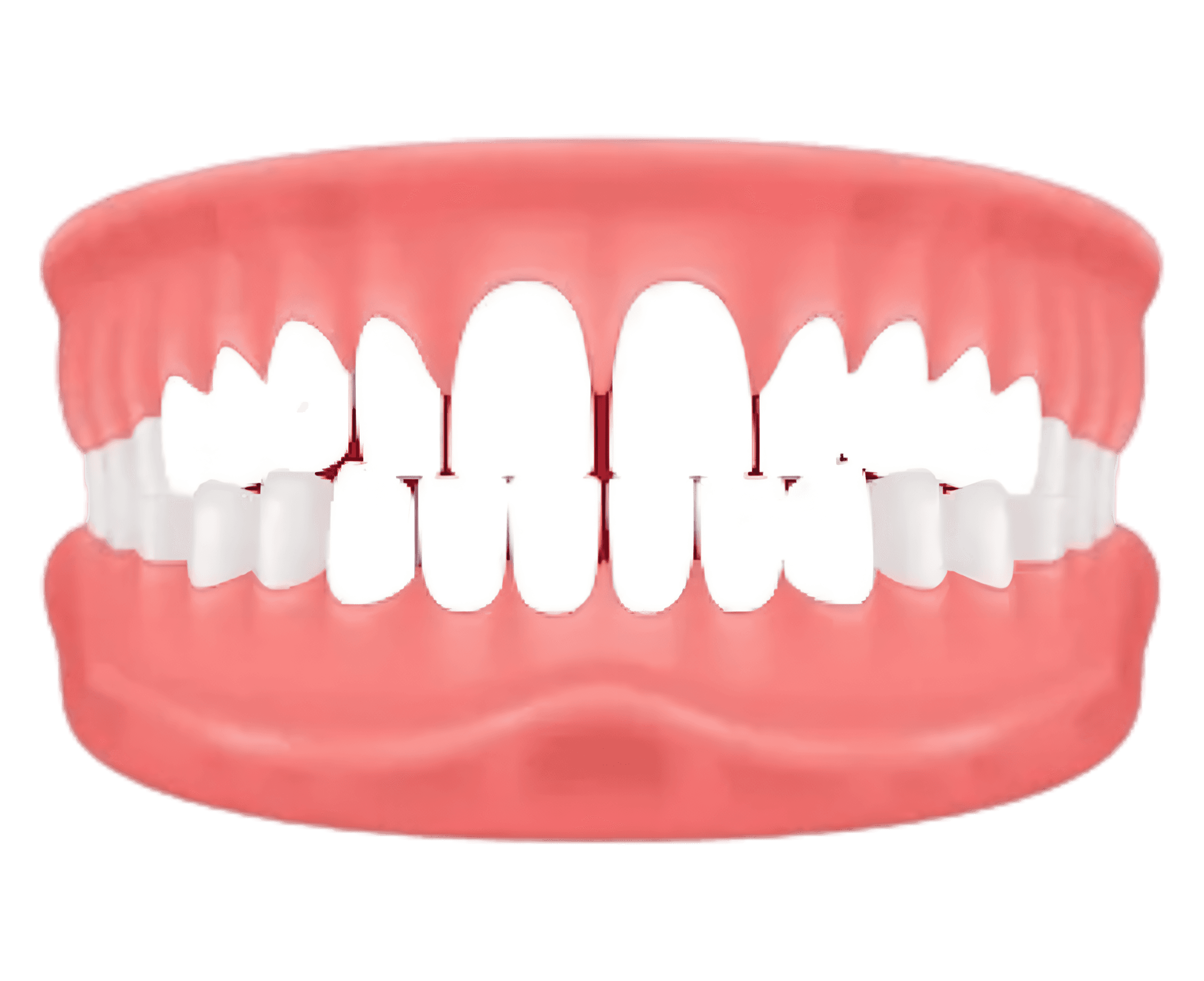 Spacing – gaps between teeth — treated with invisible aligners at Lifedent, Rajkot