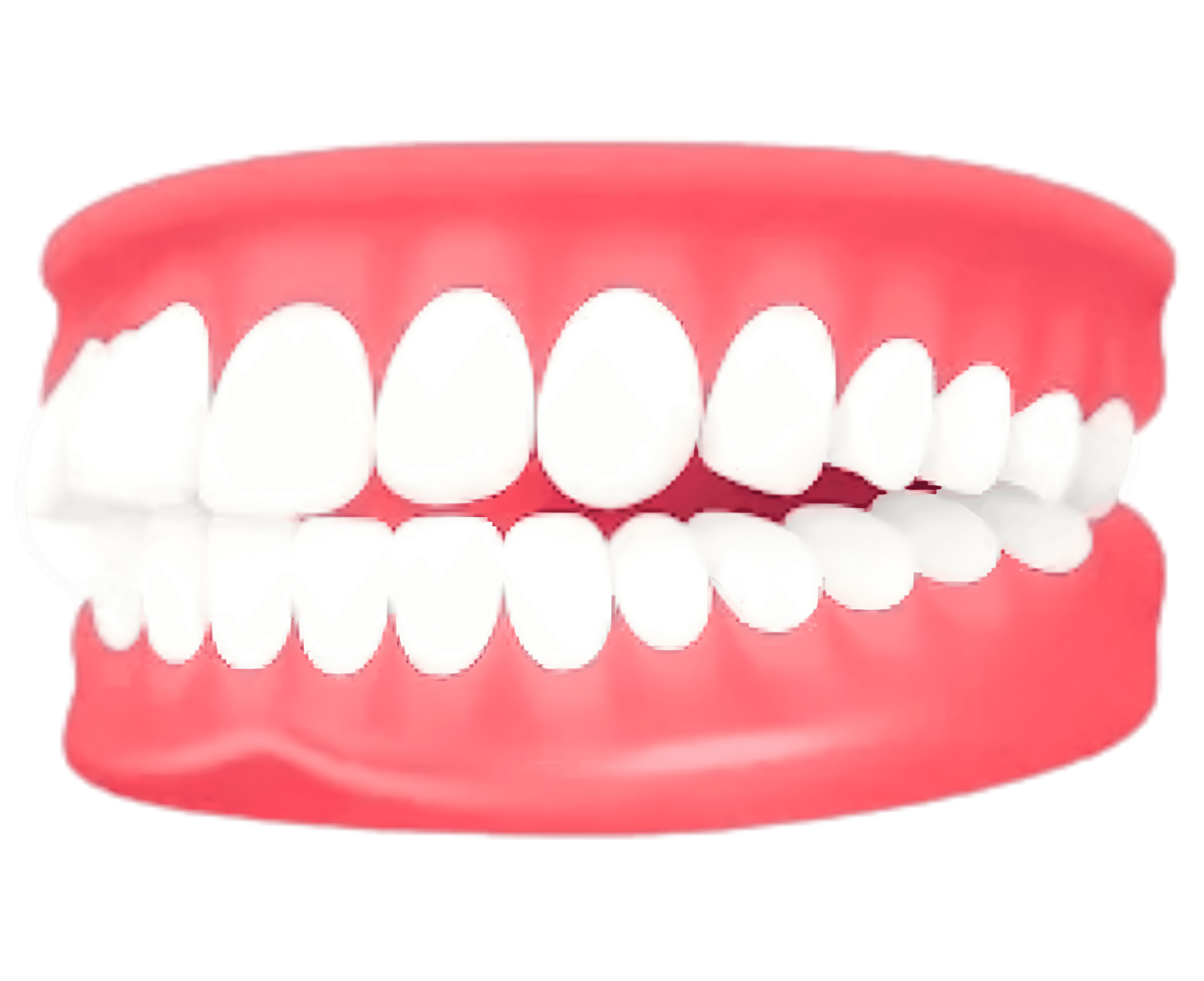 Overjet – forward-placed upper teeth