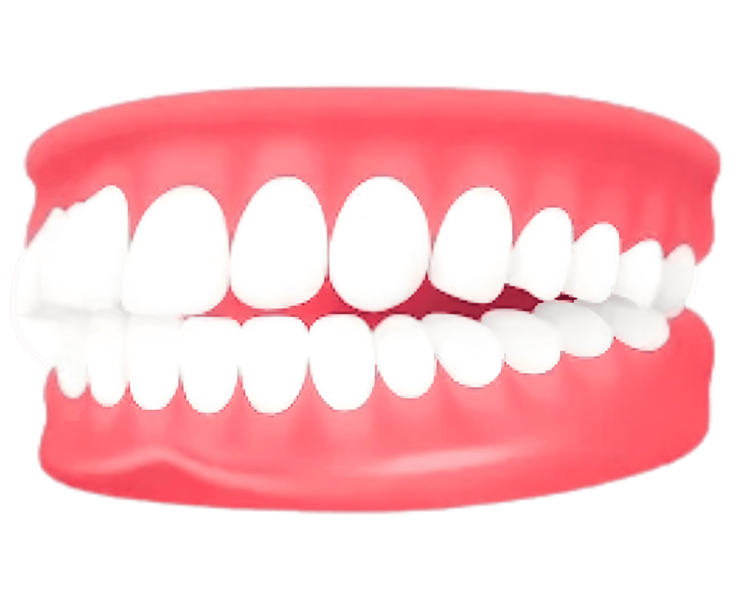 Overjet – forward-placed upper teeth — treated with invisible aligners at Lifedent, Rajkot