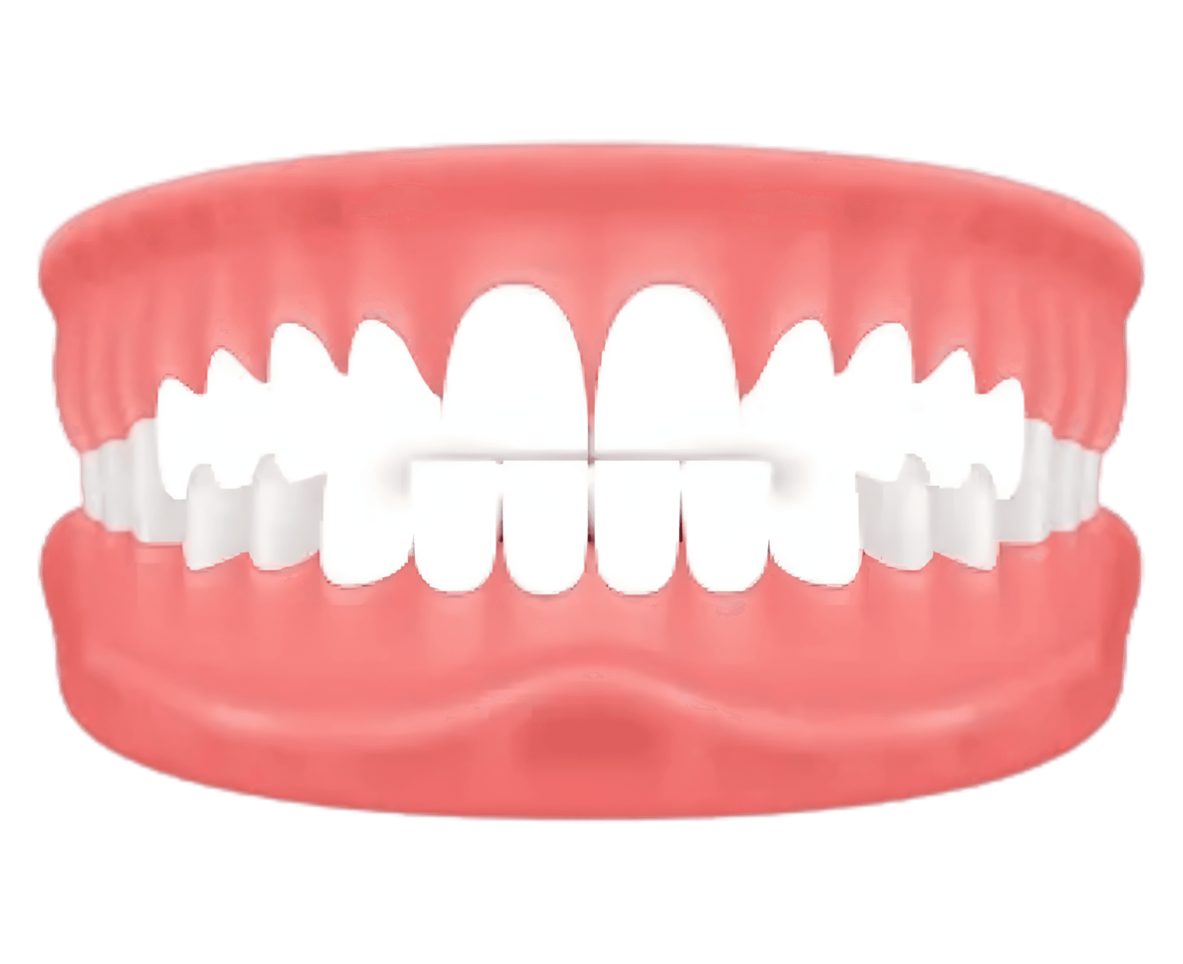 Edge-to-Edge Bite – upper and lower teeth meet directly — treated with invisible aligners at Lifedent, Rajkot