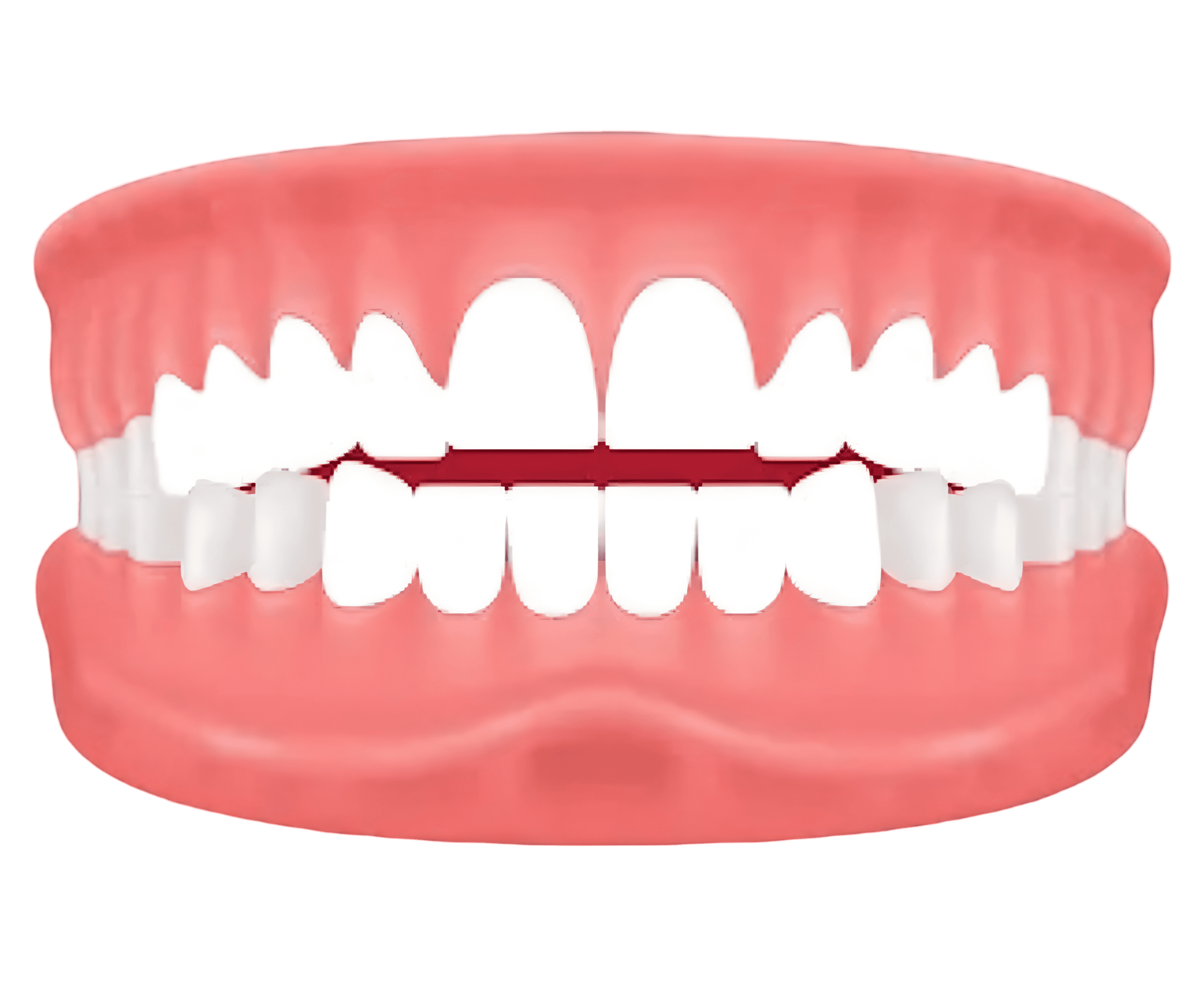 Openbite – teeth don't touch when biting