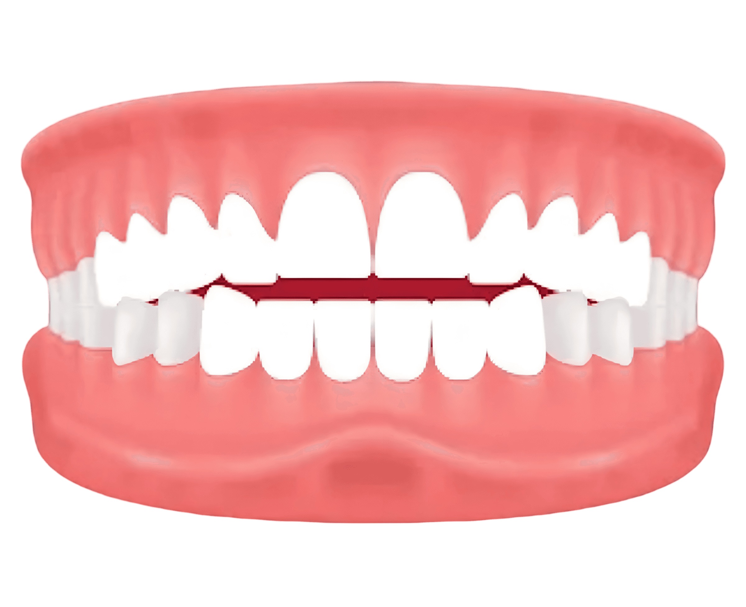 Openbite – teeth don't touch when biting — treated with invisible aligners at Lifedent, Rajkot