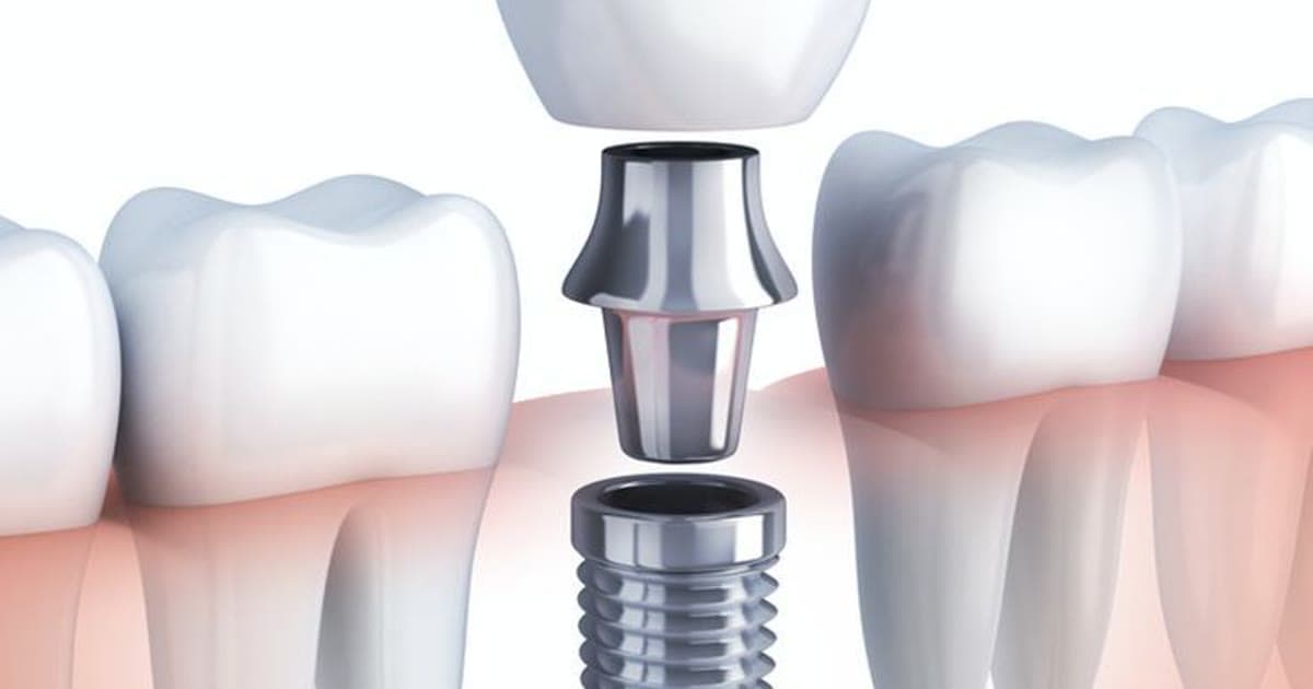Basal vs Conventional Dental Implants