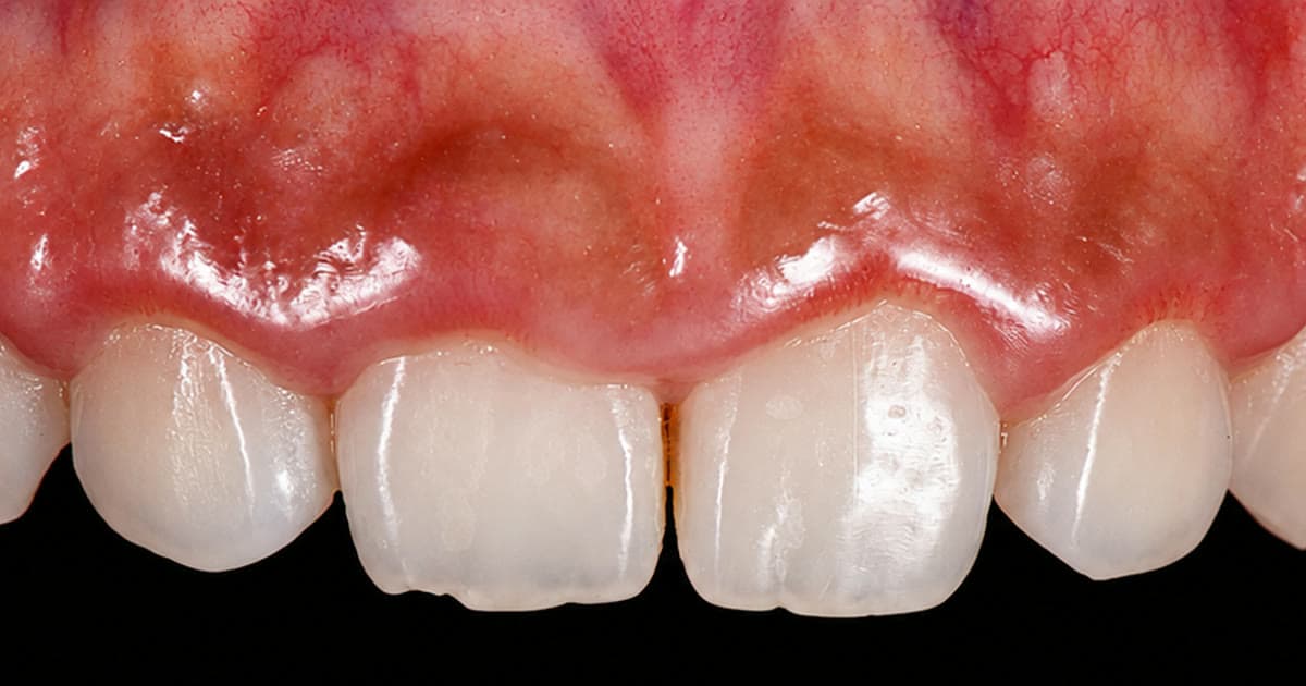 Bleeding Gums: Causes and When to Get Help