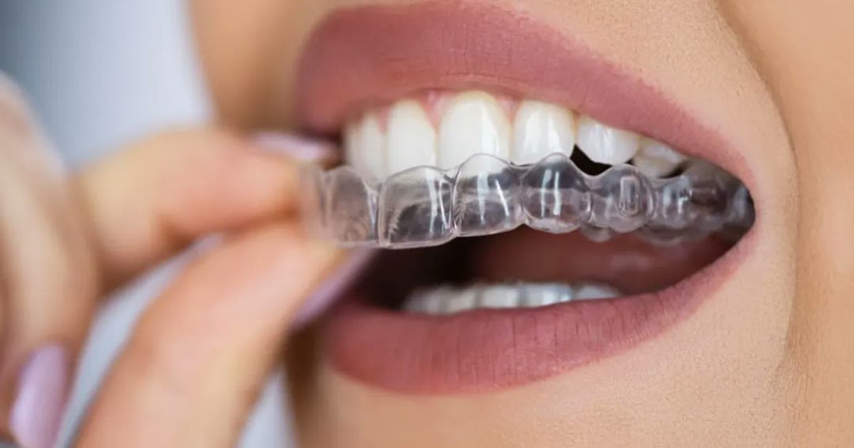 Gap Between Front Teeth: How to Close It